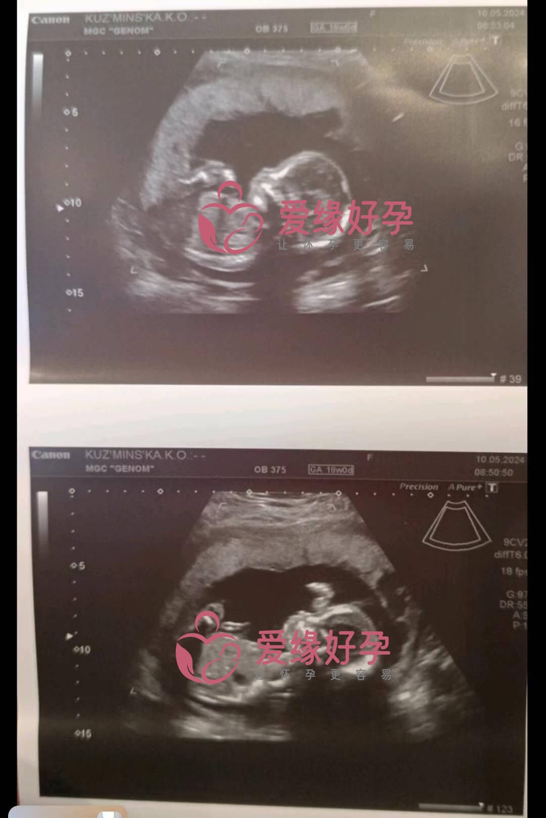 爱缘好孕:乌克兰代孕代母第18周孕检通过
