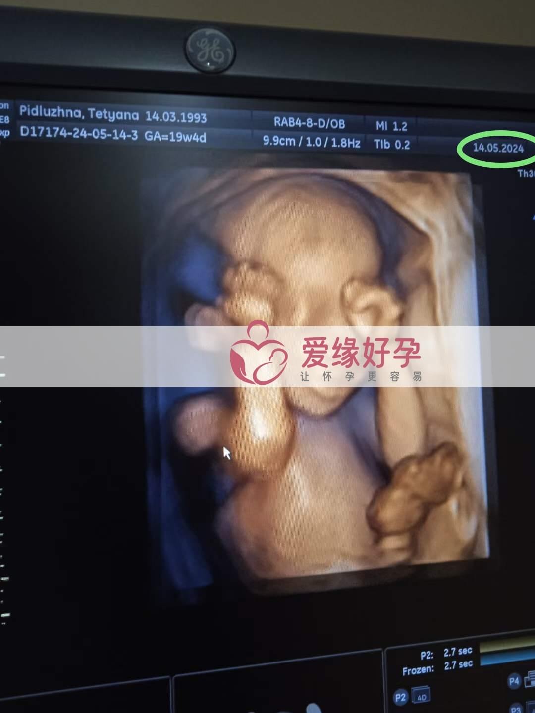 爱缘好孕:乌克兰代孕代母18周孕检顺利通过