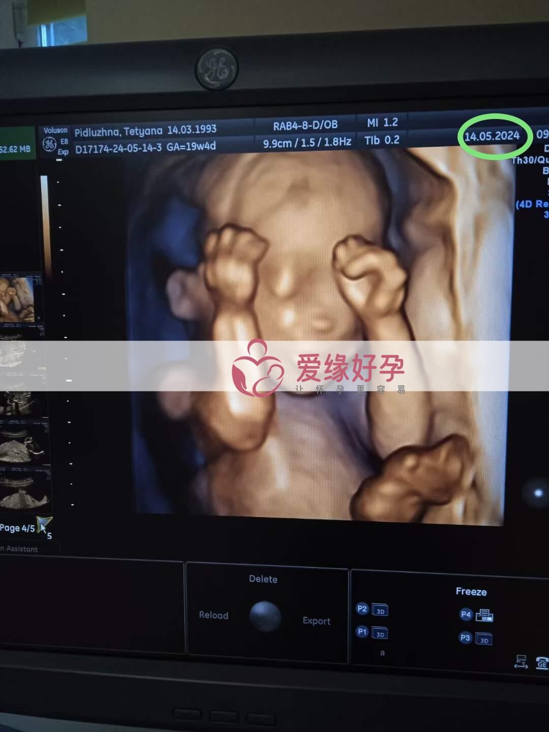 爱缘好孕:乌克兰代孕代母18周孕检顺利通过