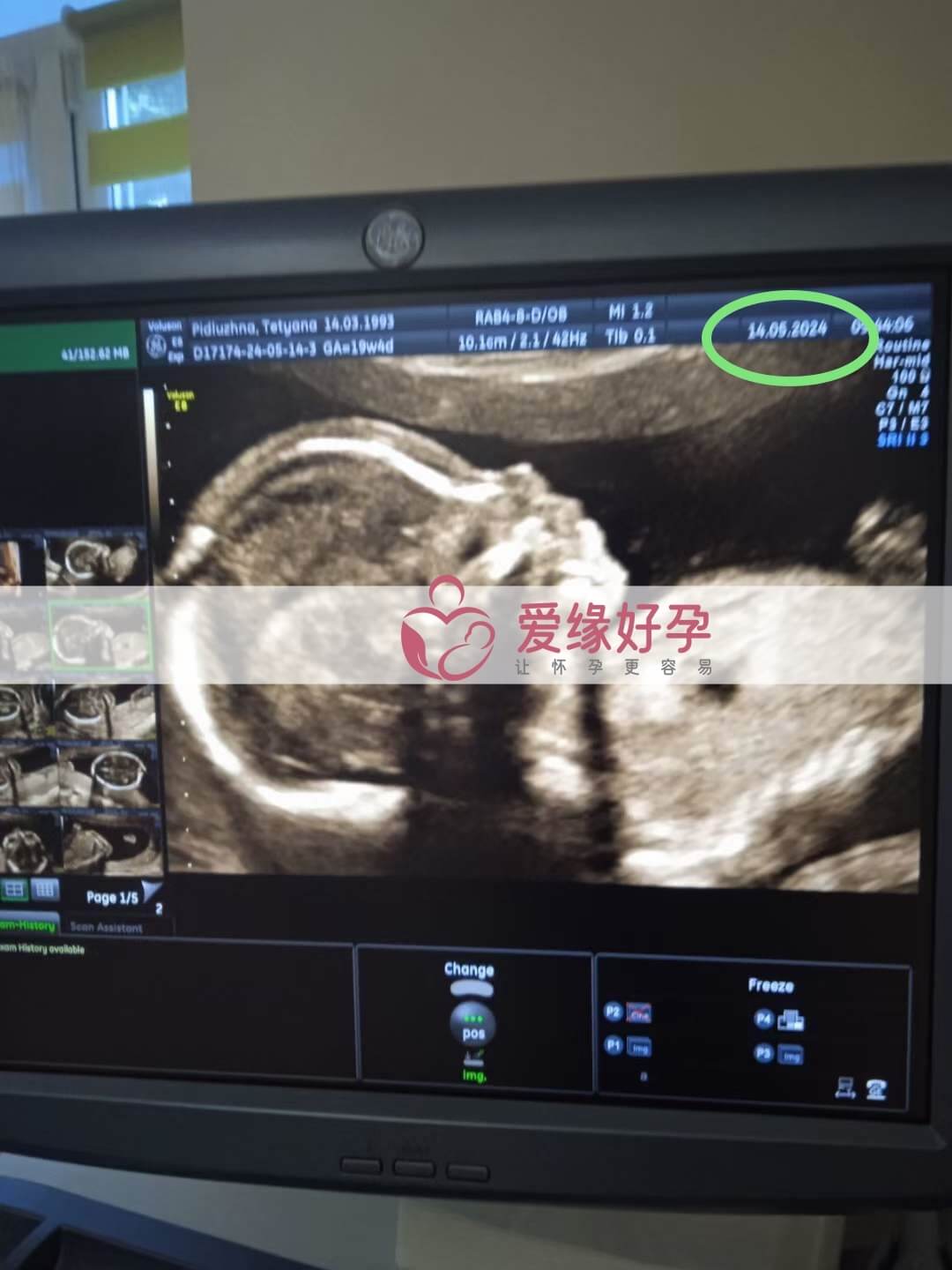爱缘好孕:乌克兰代孕代母18周孕检顺利通过