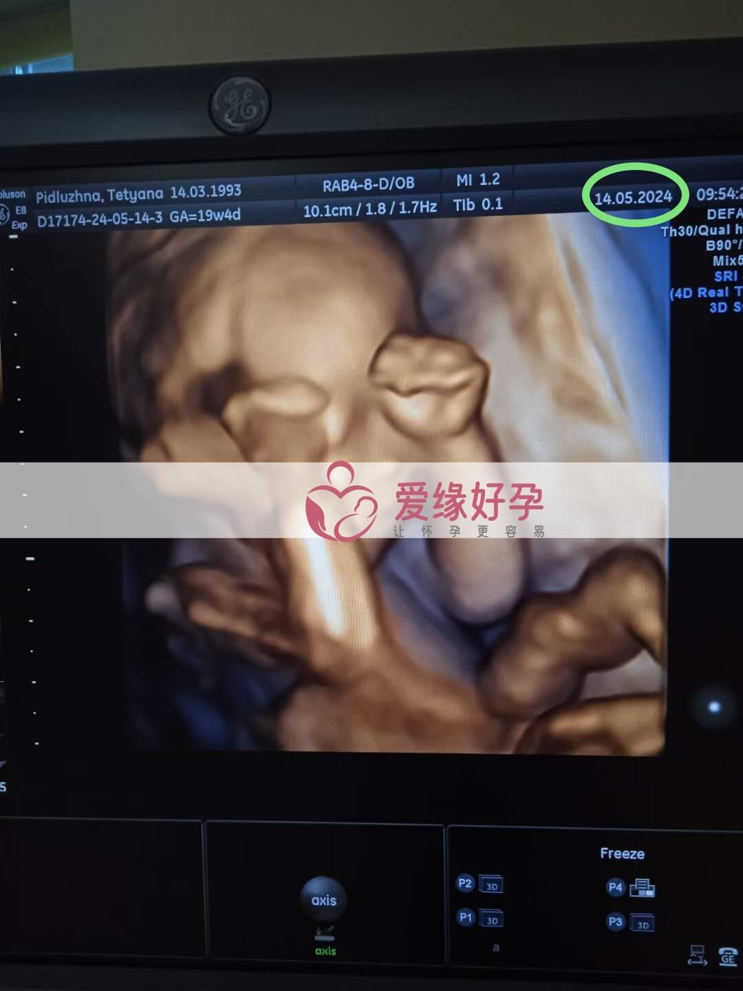 爱缘好孕:乌克兰代孕代母18周孕检顺利通过