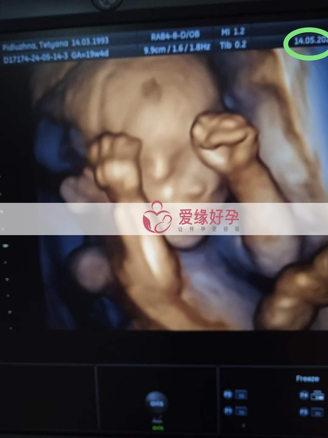 爱缘好孕:乌克兰代孕代母18周孕检顺利通过