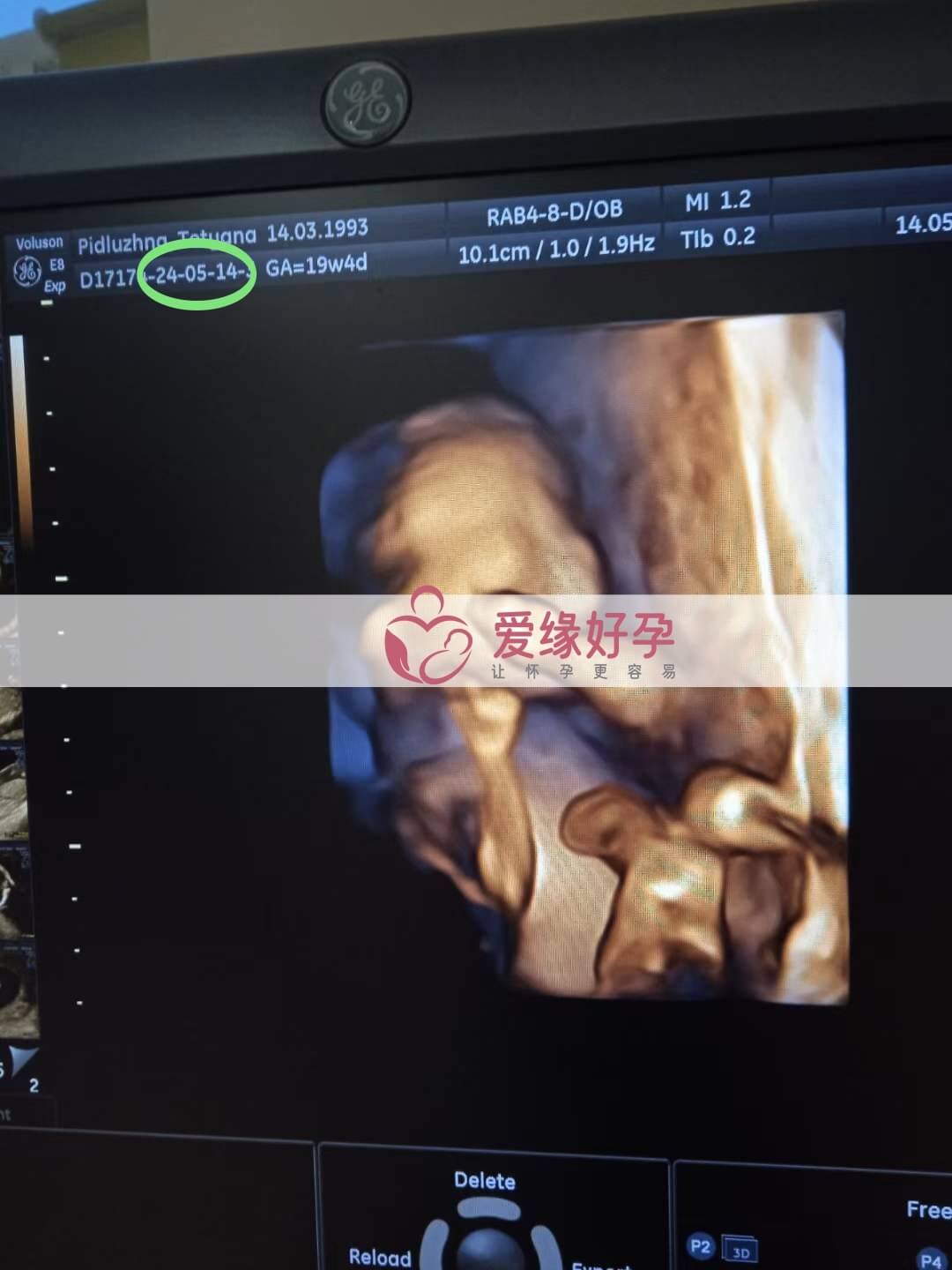 爱缘好孕:乌克兰代孕代母18周孕检顺利通过