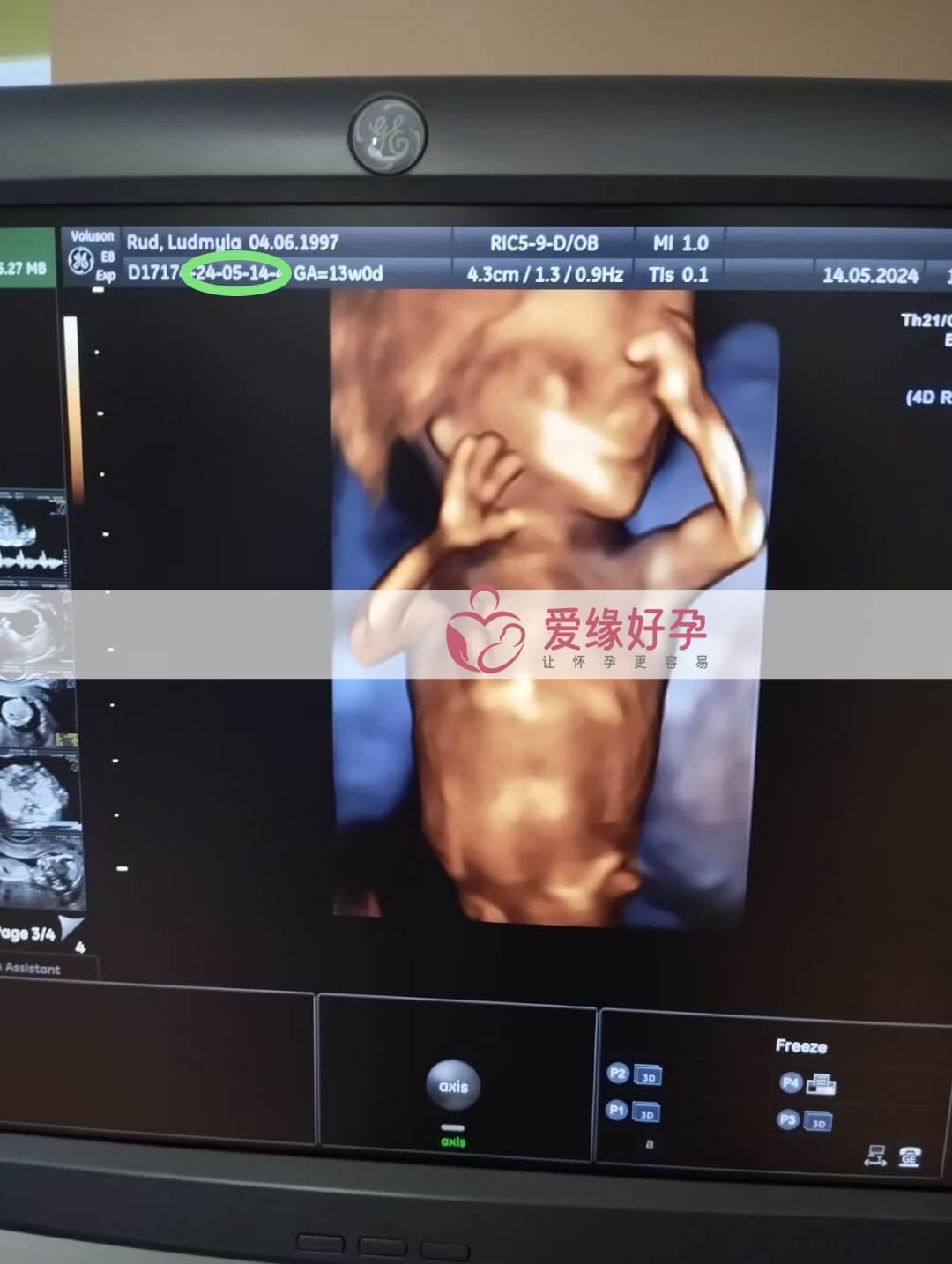爱缘好孕:乌克兰代孕代母12周孕检顺利通过