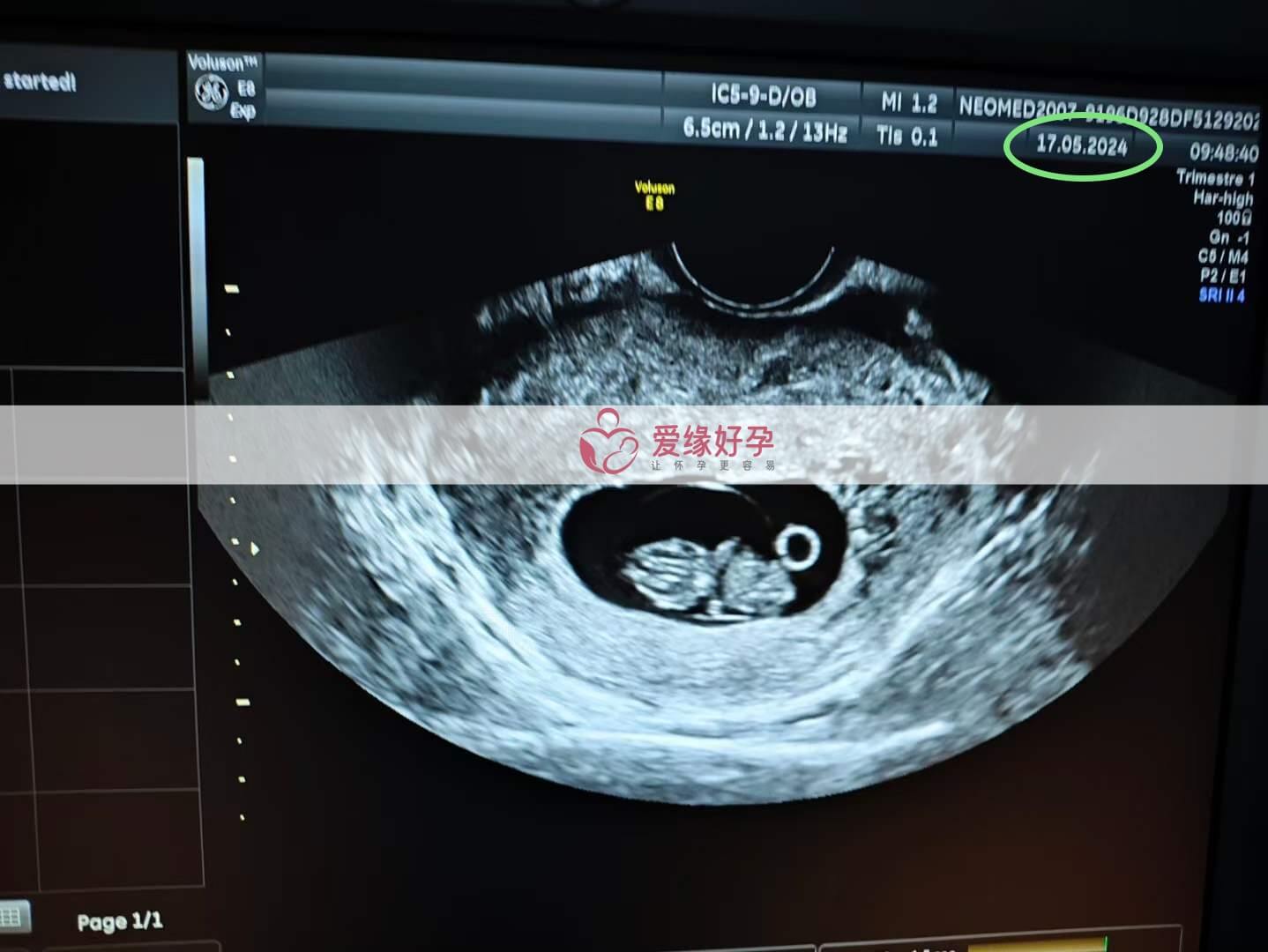 爱缘好孕:乌克兰代孕代母9周孕检顺利通过