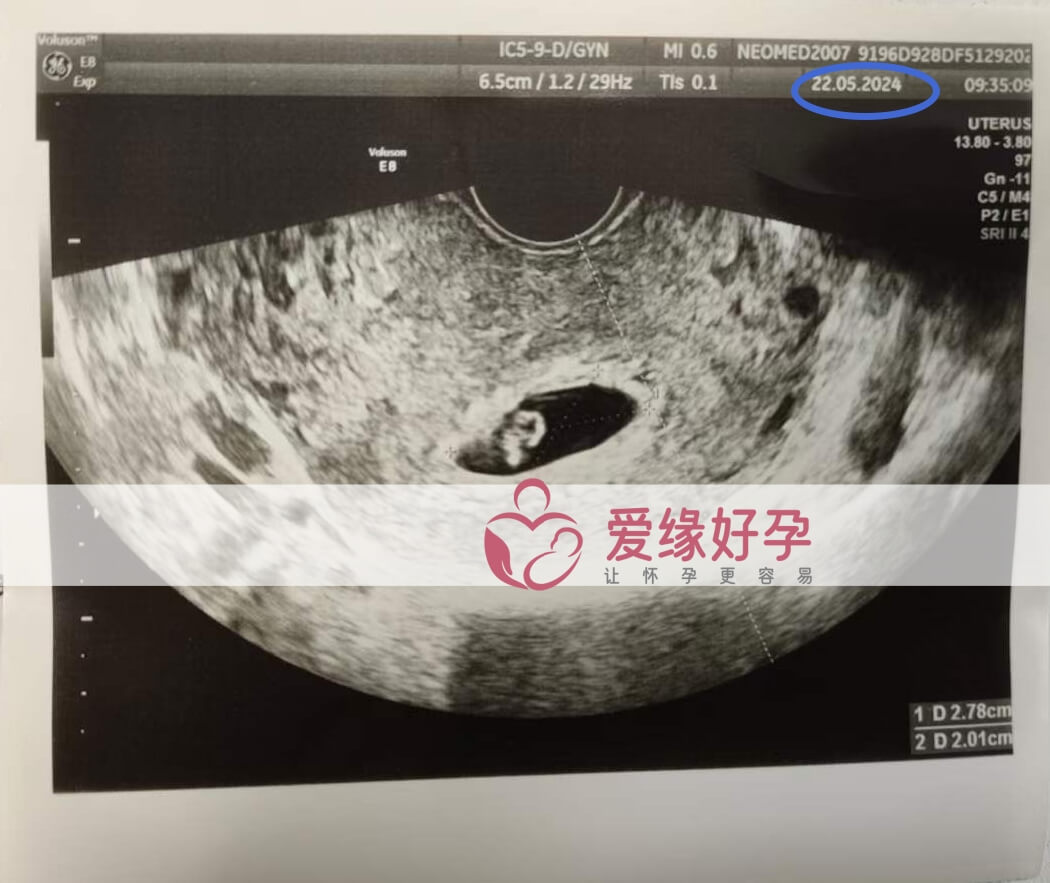 爱缘好孕:格鲁吉亚代孕代母第一次B超产检顺利通过