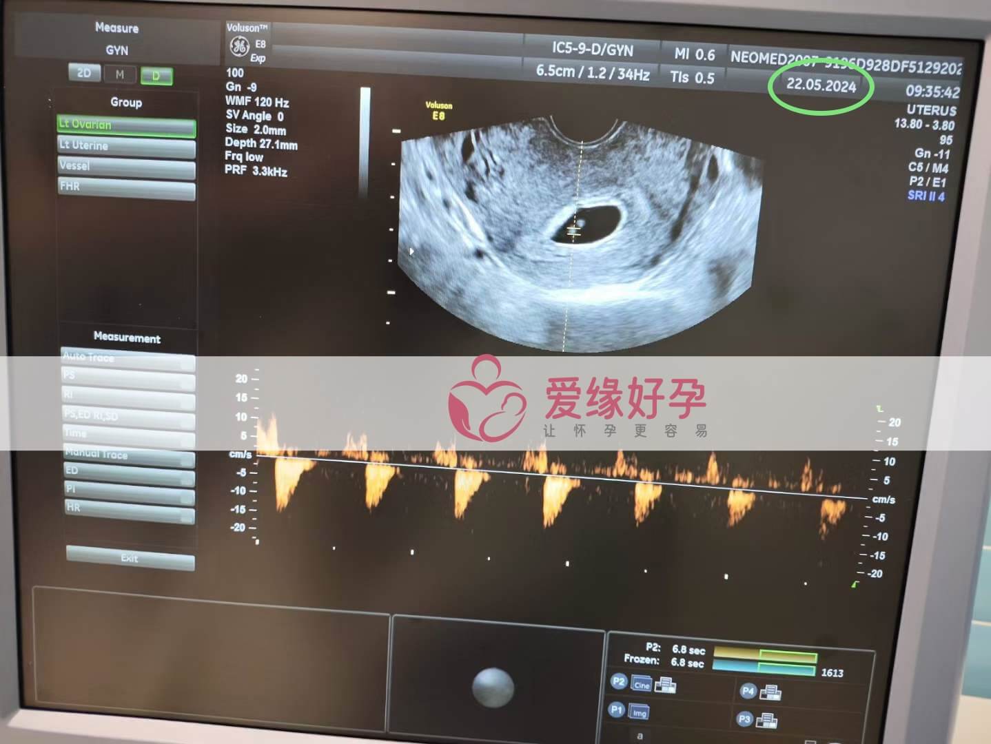 爱缘好孕:格鲁吉亚代孕代母第一次B超产检顺利通过