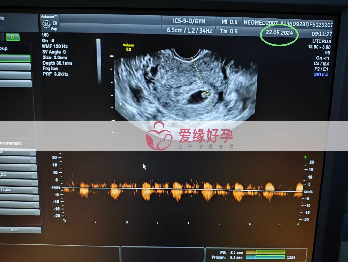 爱缘好孕:乌克兰代孕代母孕6周产检顺利通过