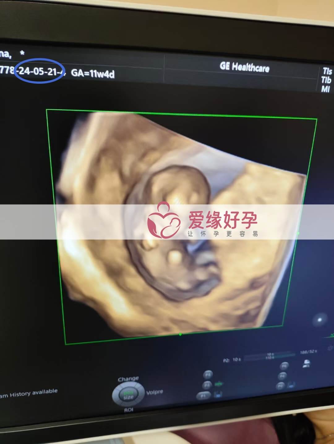爱缘好孕:乌克兰代孕代母孕11周+5天产检顺利通过