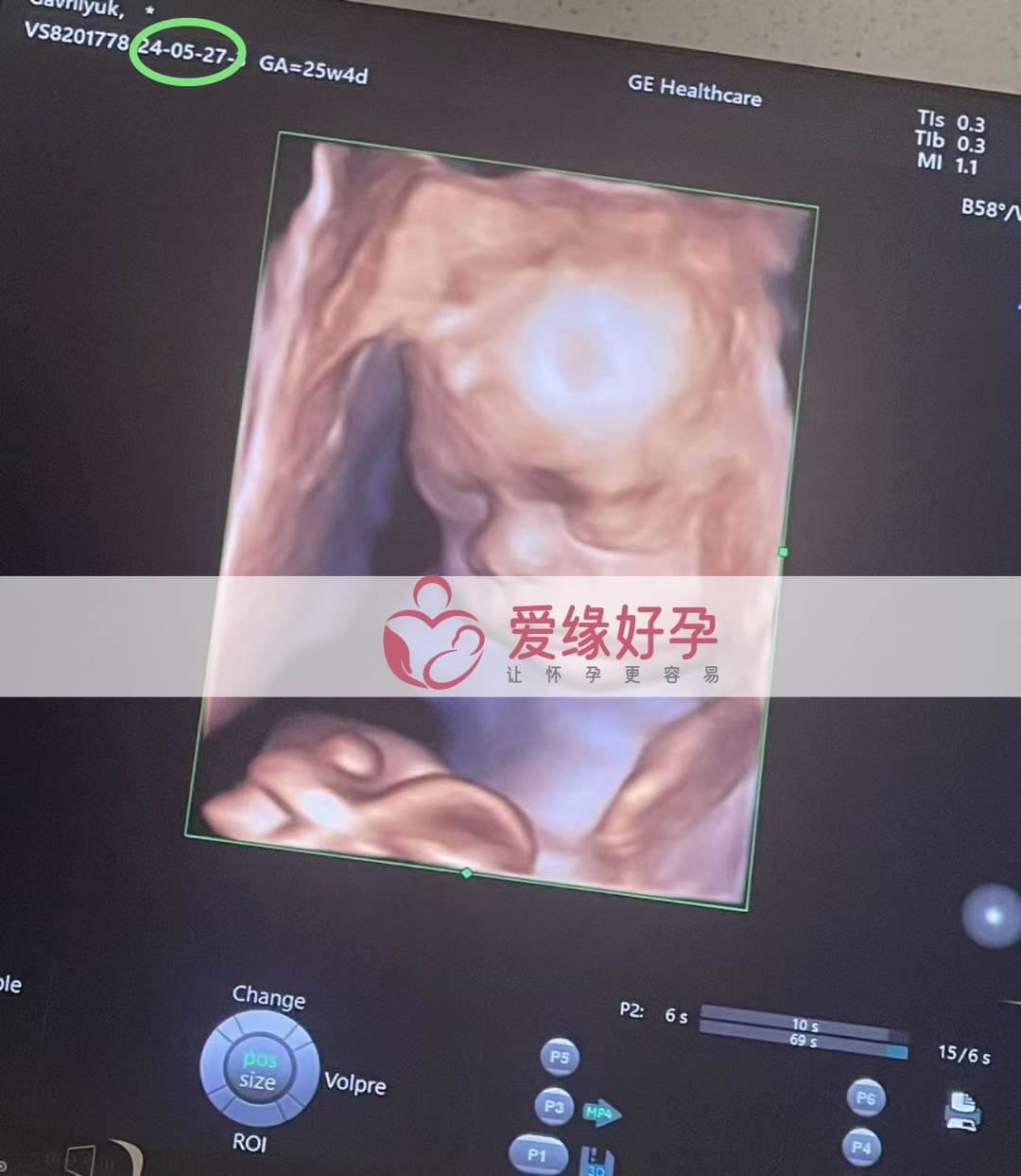 爱缘好孕:乌克兰代孕代母25周孕检顺利通过