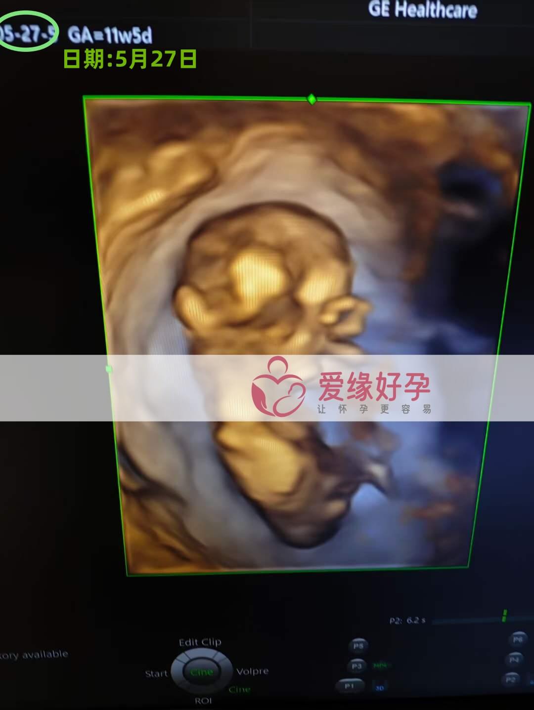 爱缘好孕:乌克兰代孕代母NT检查顺利通过