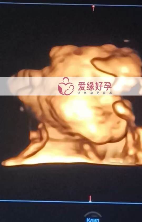 爱缘好孕:哈萨克斯坦代孕代母孕30周产检顺利通过