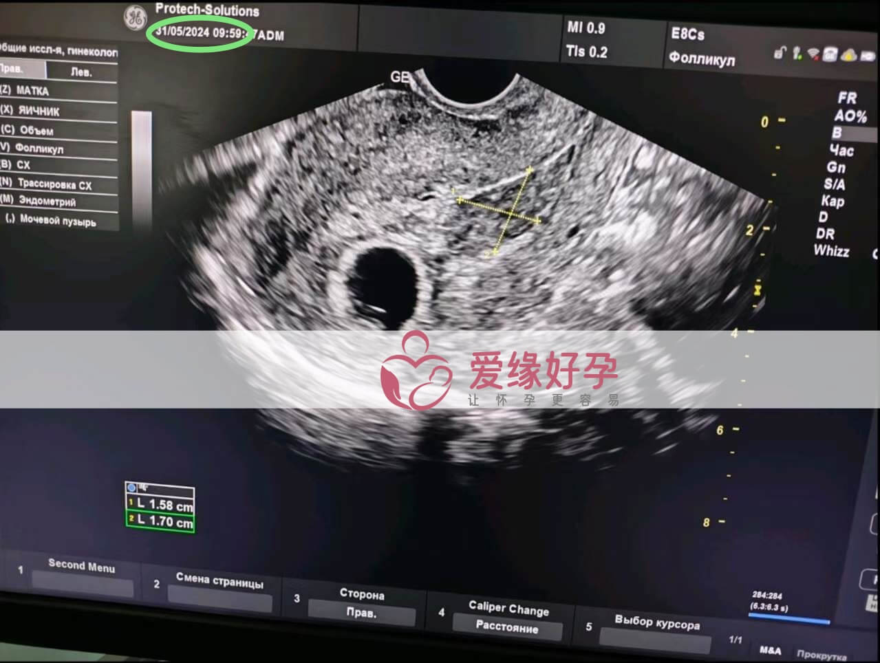 爱缘好孕:乌克兰代孕代母第一次产检顺利通过