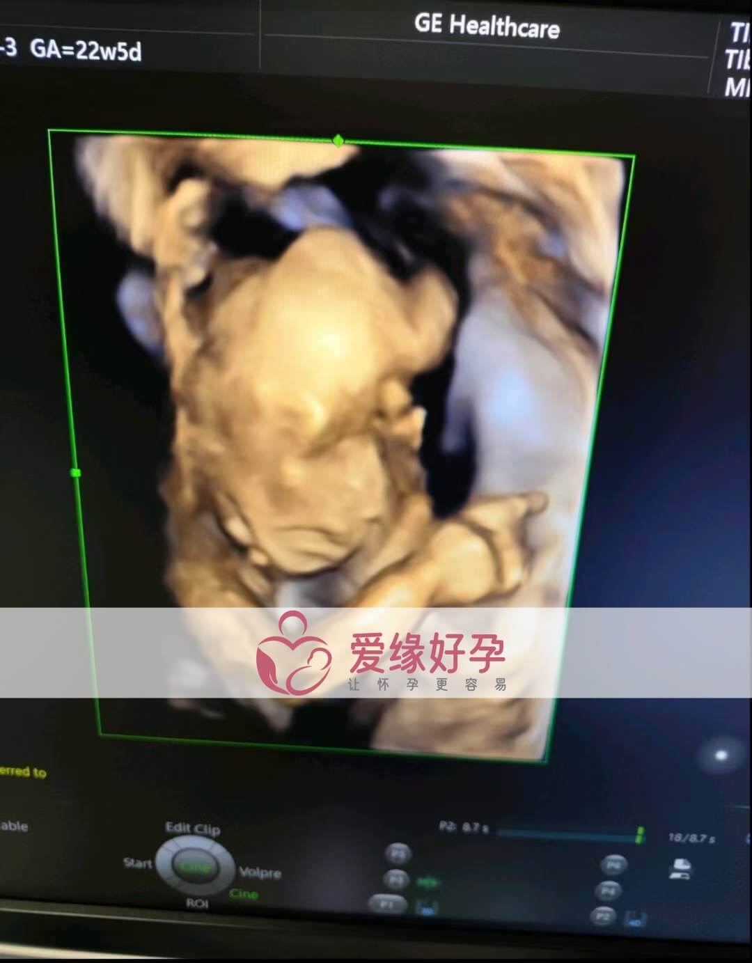 爱缘好孕:乌克兰代孕代母孕22周产检顺利通过