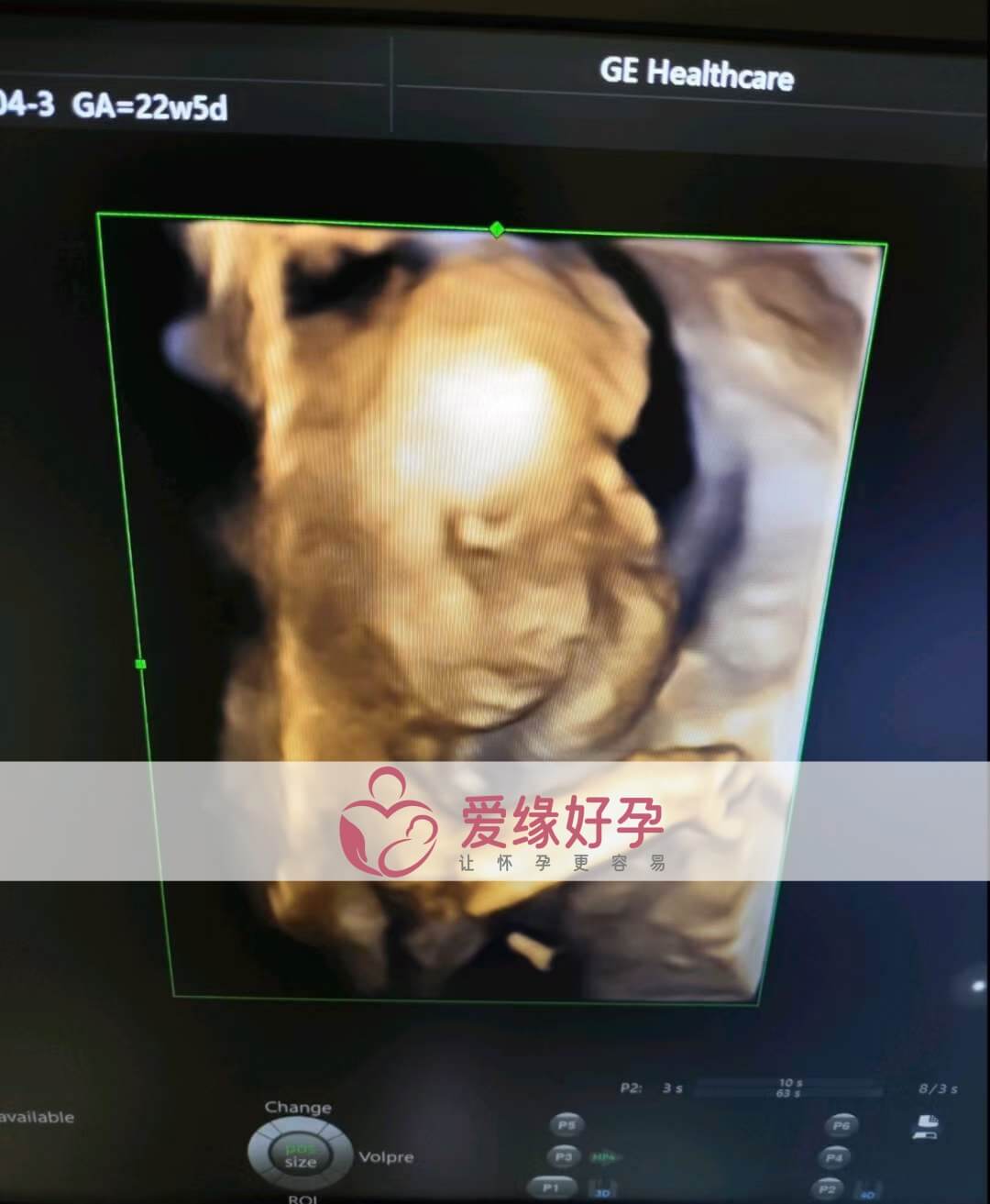 爱缘好孕:乌克兰代孕代母孕22周产检顺利通过