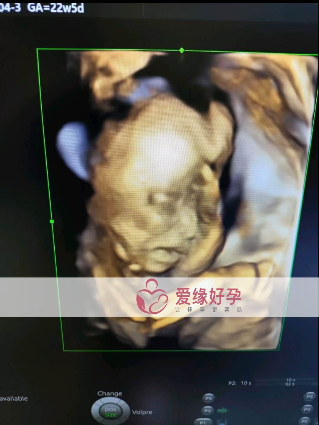 爱缘好孕:乌克兰代孕代母孕22周产检顺利通过