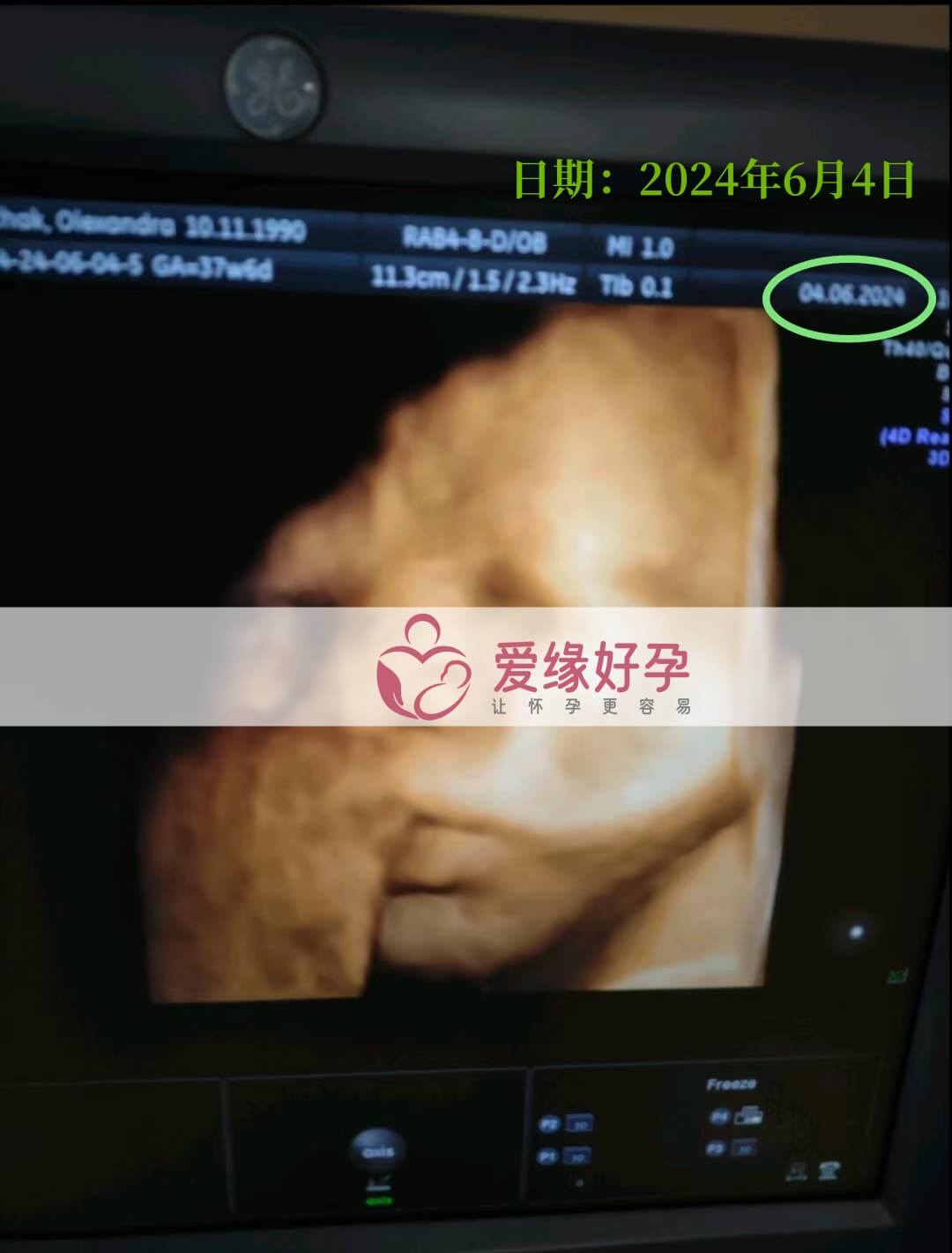 爱缘好孕:乌克兰代孕代母孕37周产检顺利通过