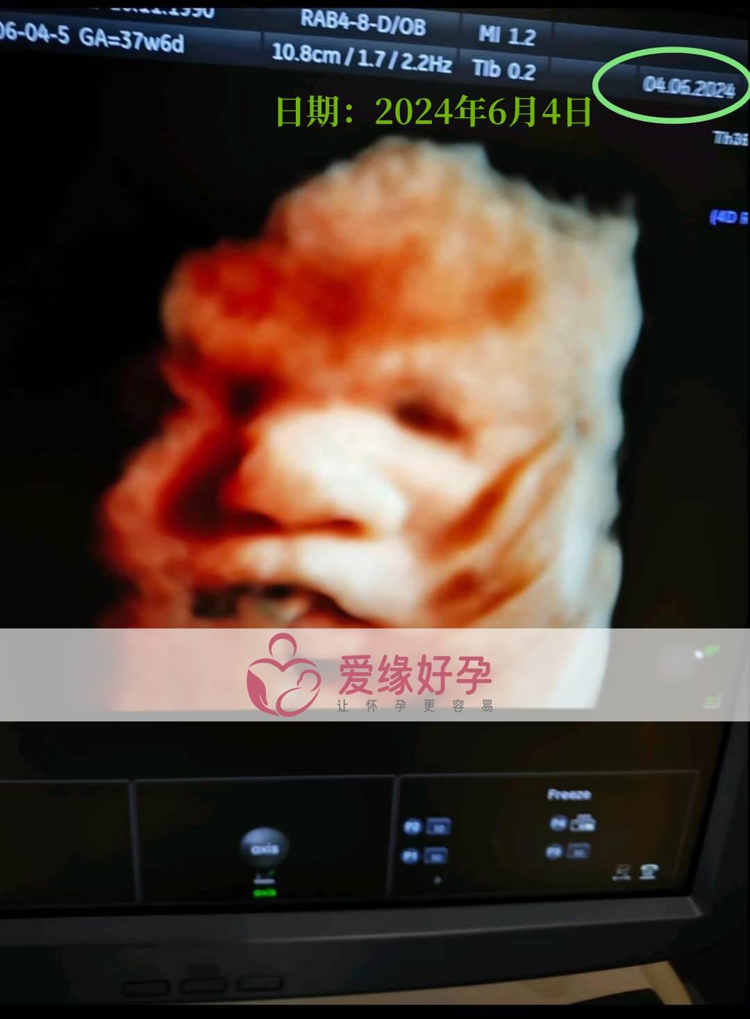 爱缘好孕:乌克兰代孕代母孕37周产检顺利通过