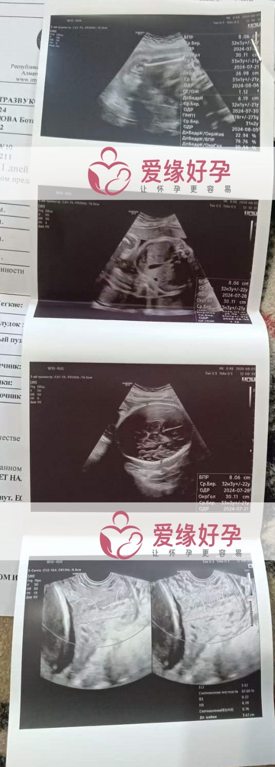 爱缘好孕:哈萨克斯坦代孕代母孕31周产检顺利通过
