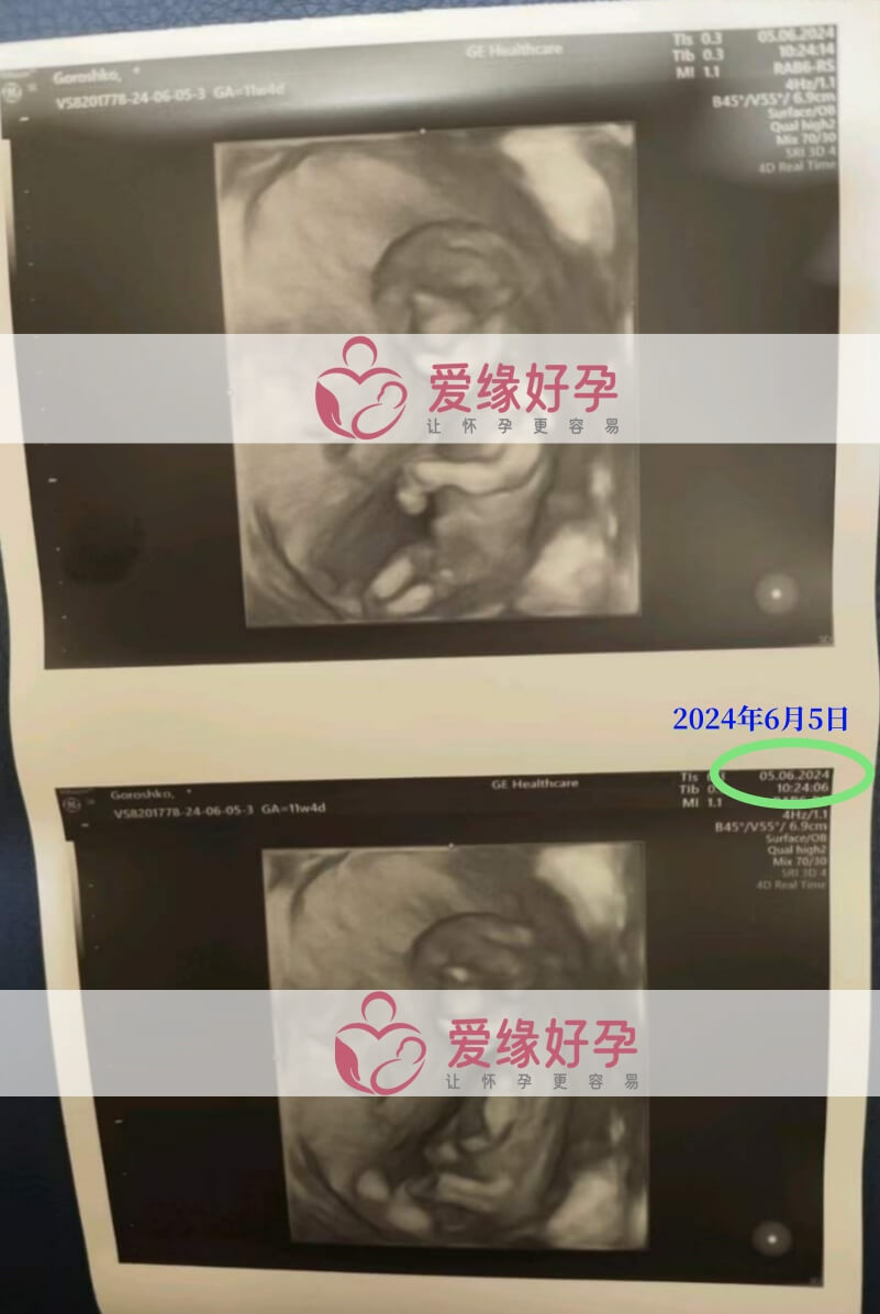 爱缘好孕:乌克兰代孕代母孕12周产检顺利通过