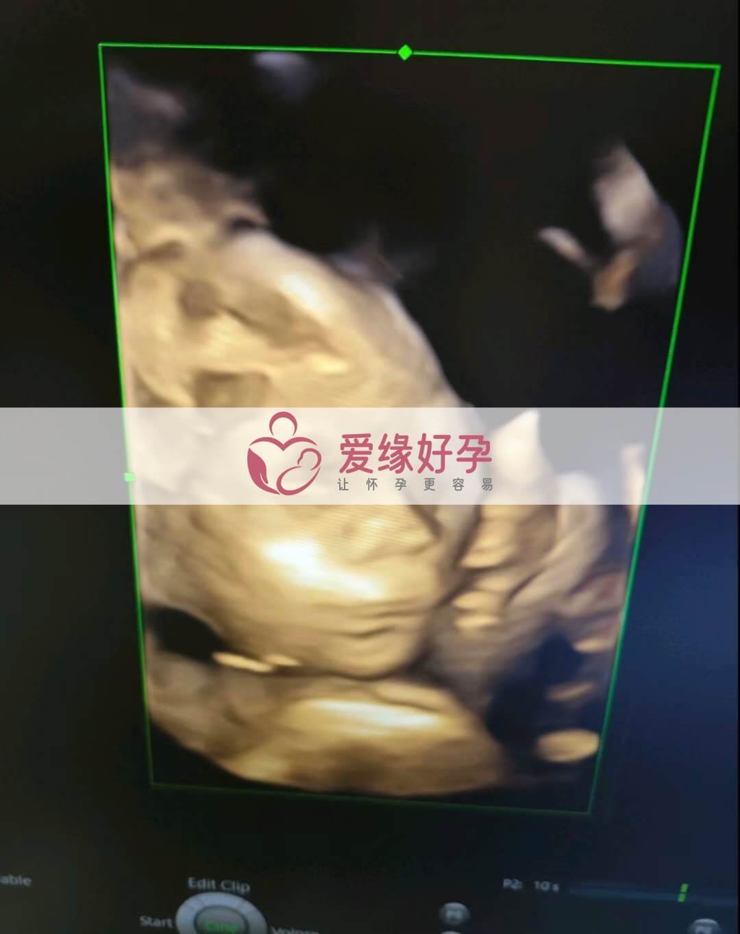 爱缘好孕:乌克兰代孕代母孕21周产检顺利通过