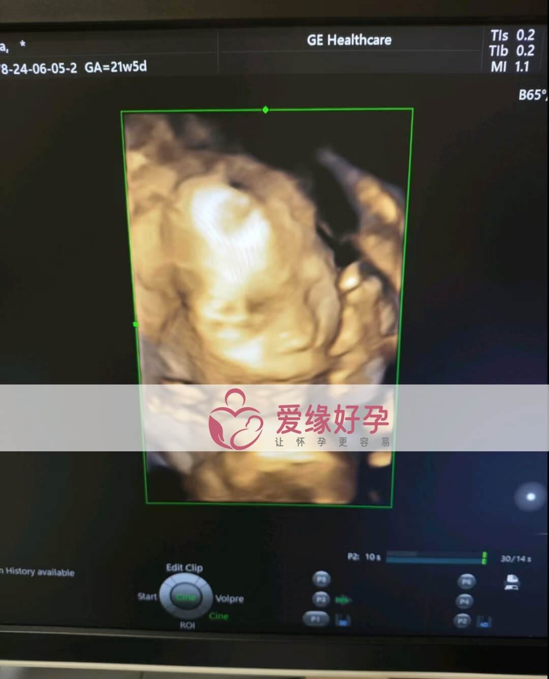 爱缘好孕:乌克兰代孕代母孕21周产检顺利通过