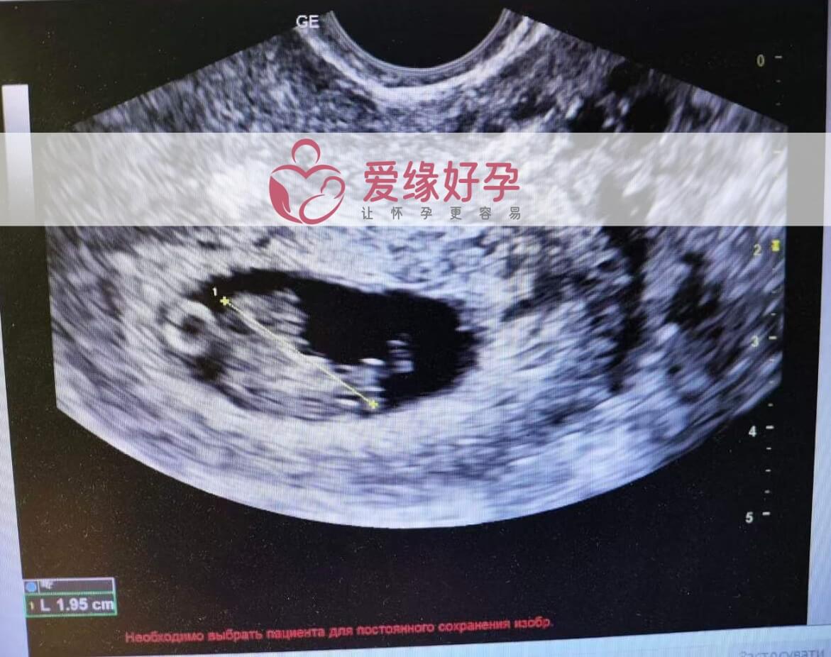 爱缘好孕:乌克兰代孕代母孕8周产检顺利通过