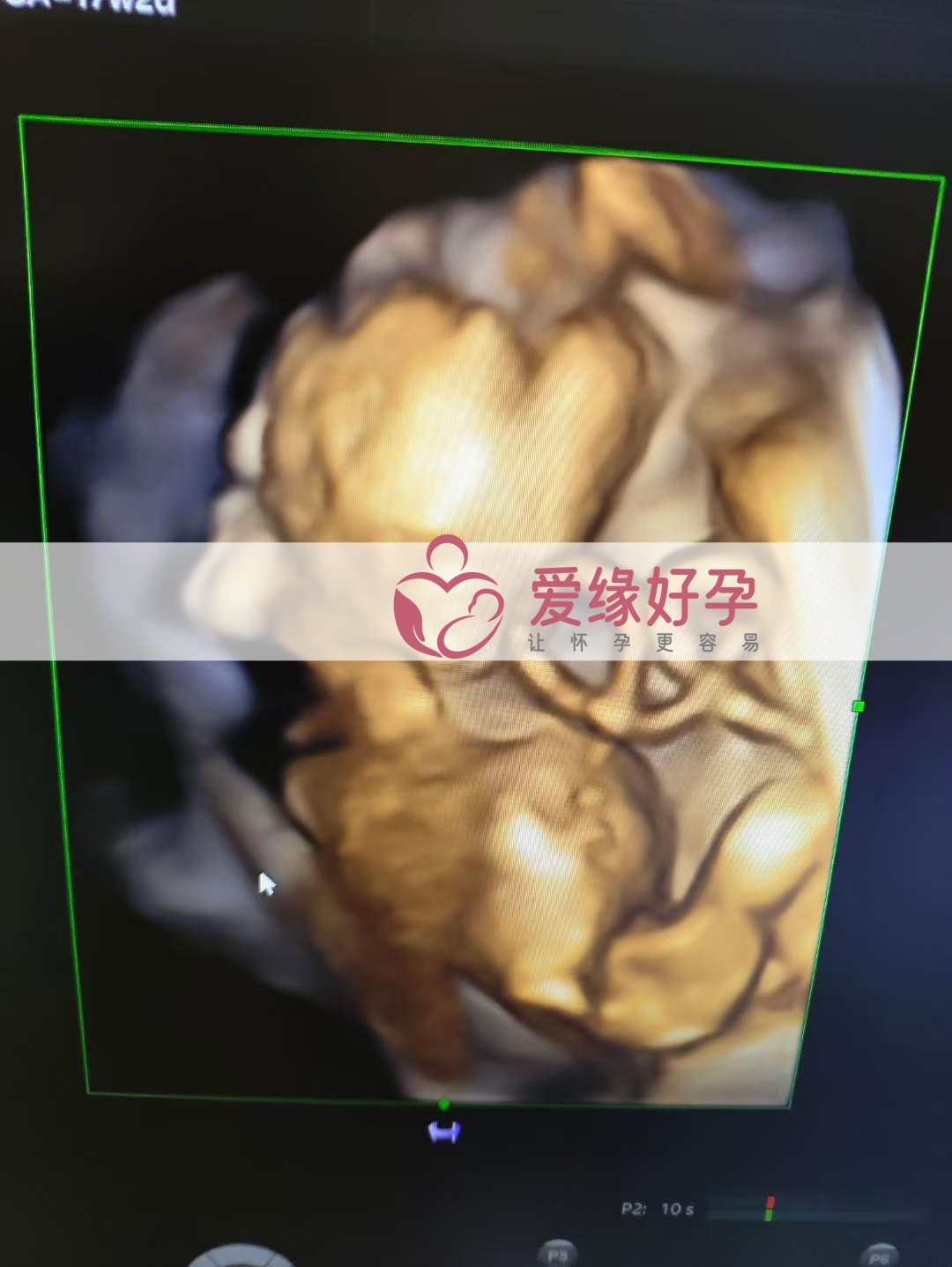 爱缘好孕:乌克兰代孕代母孕17周产检顺利通过