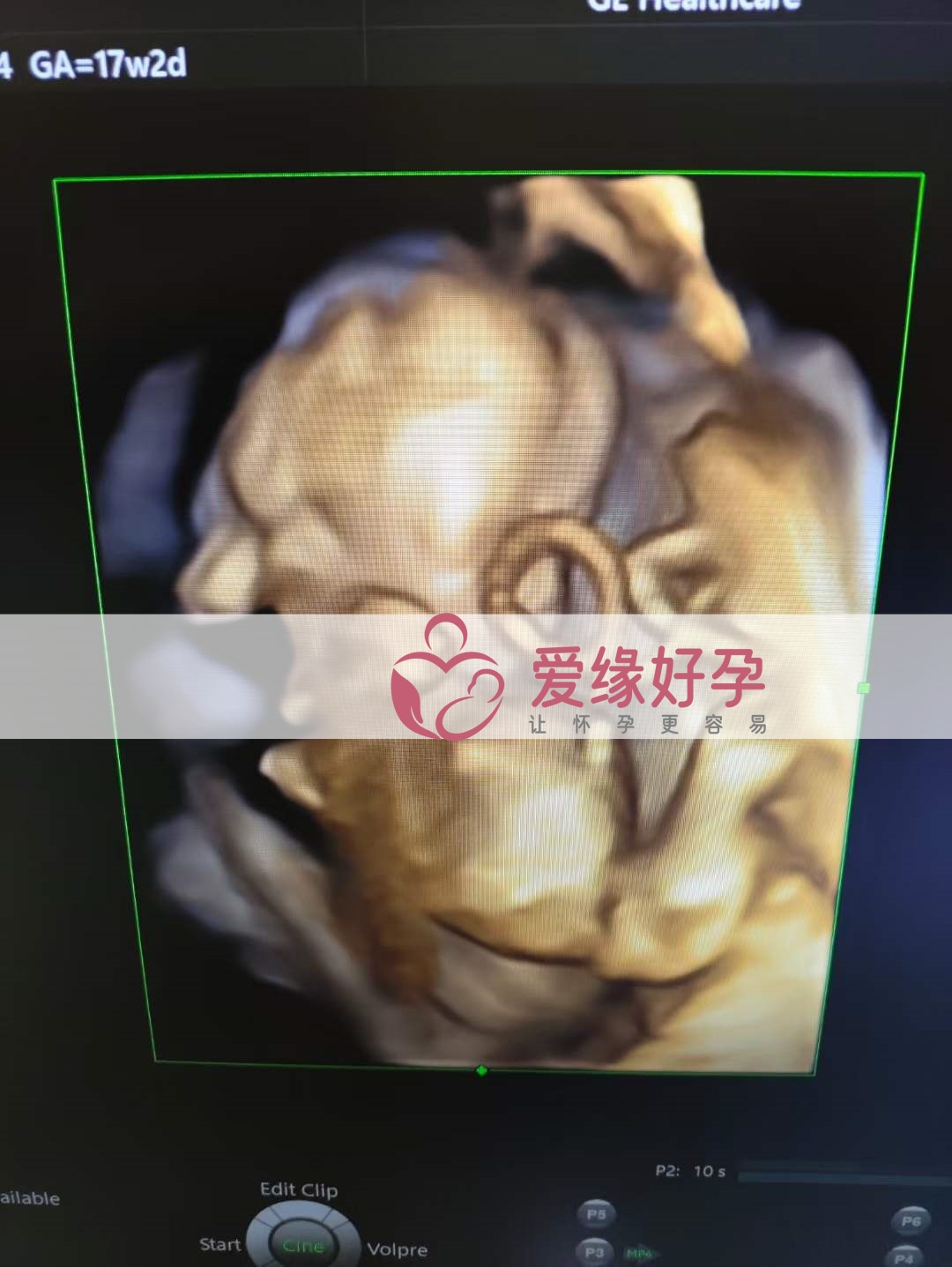 爱缘好孕:乌克兰代孕代母孕17周产检顺利通过