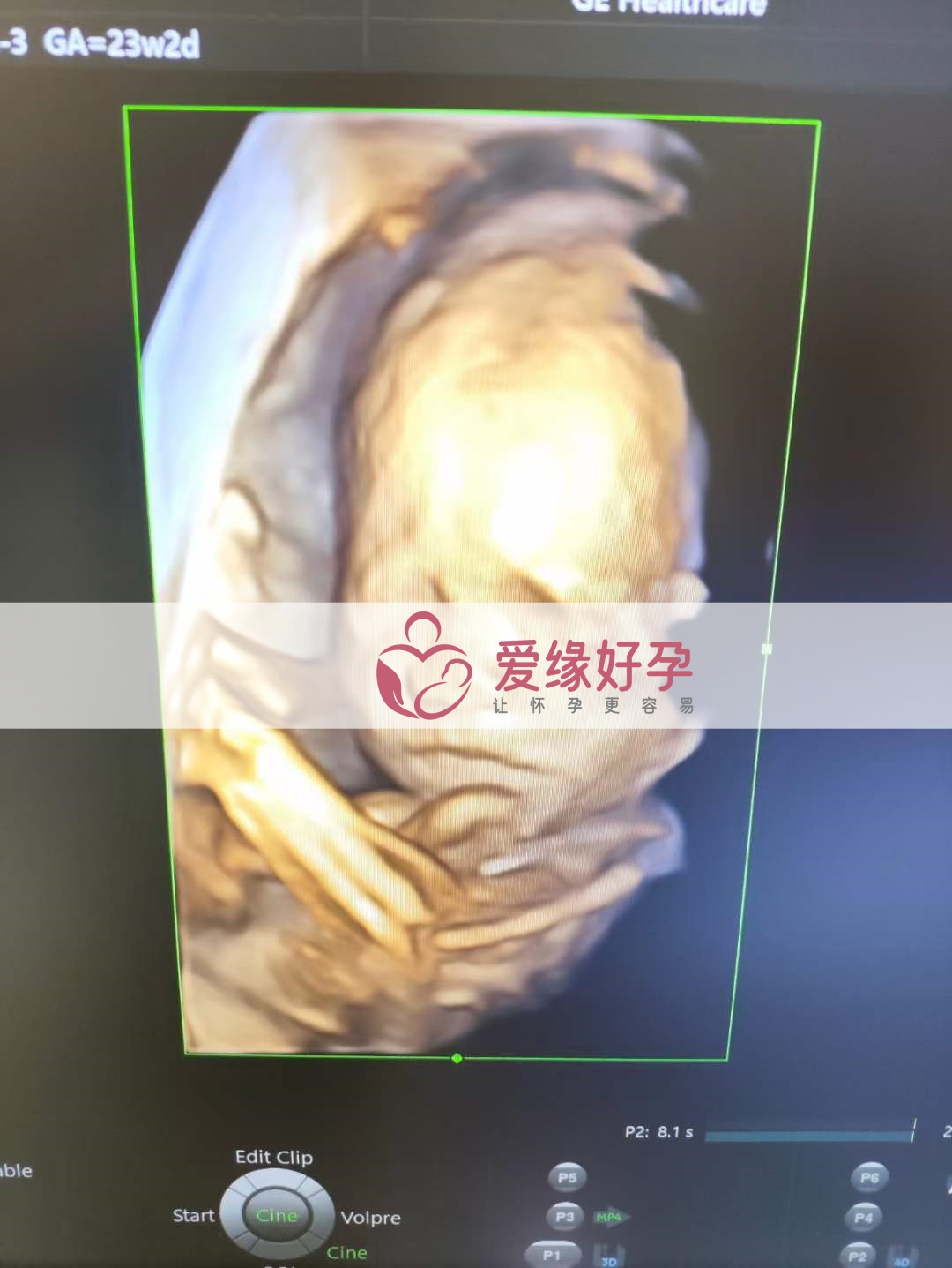 爱缘好孕:乌克兰代孕代母孕23周产检顺利通过