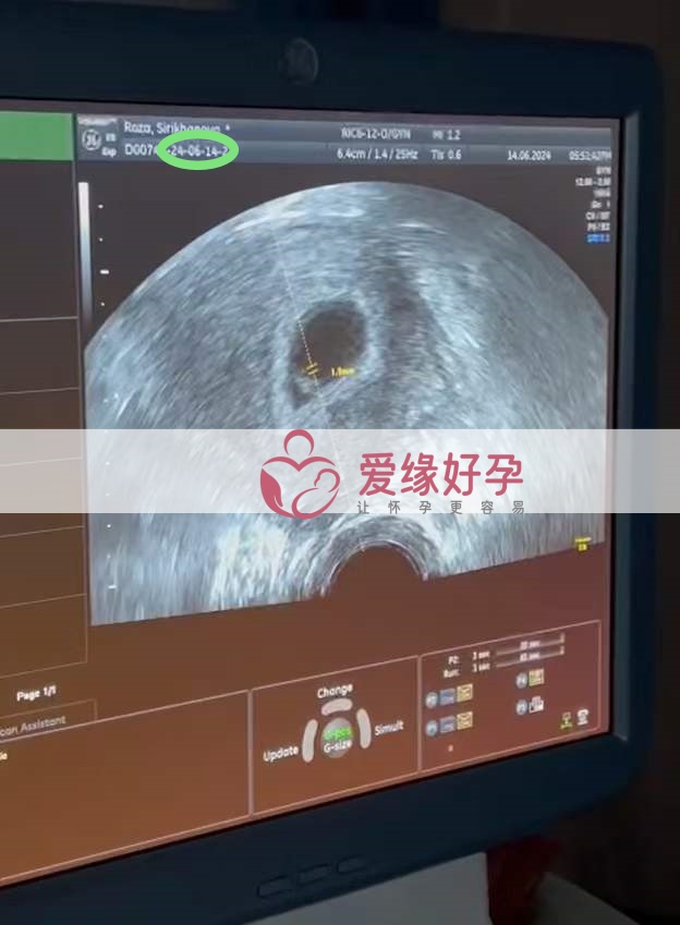 爱缘好孕:格鲁吉亚代孕代母第一次B超产检顺利通过