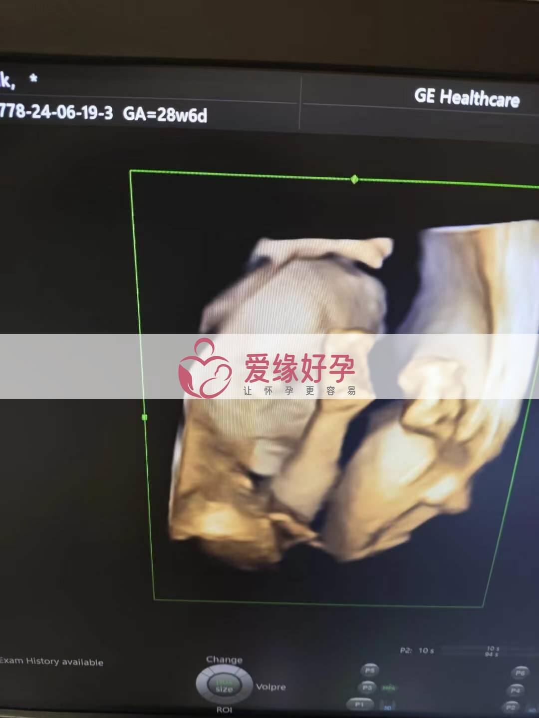 爱缘好孕乌克兰代孕代母孕28周产检顺利通过
