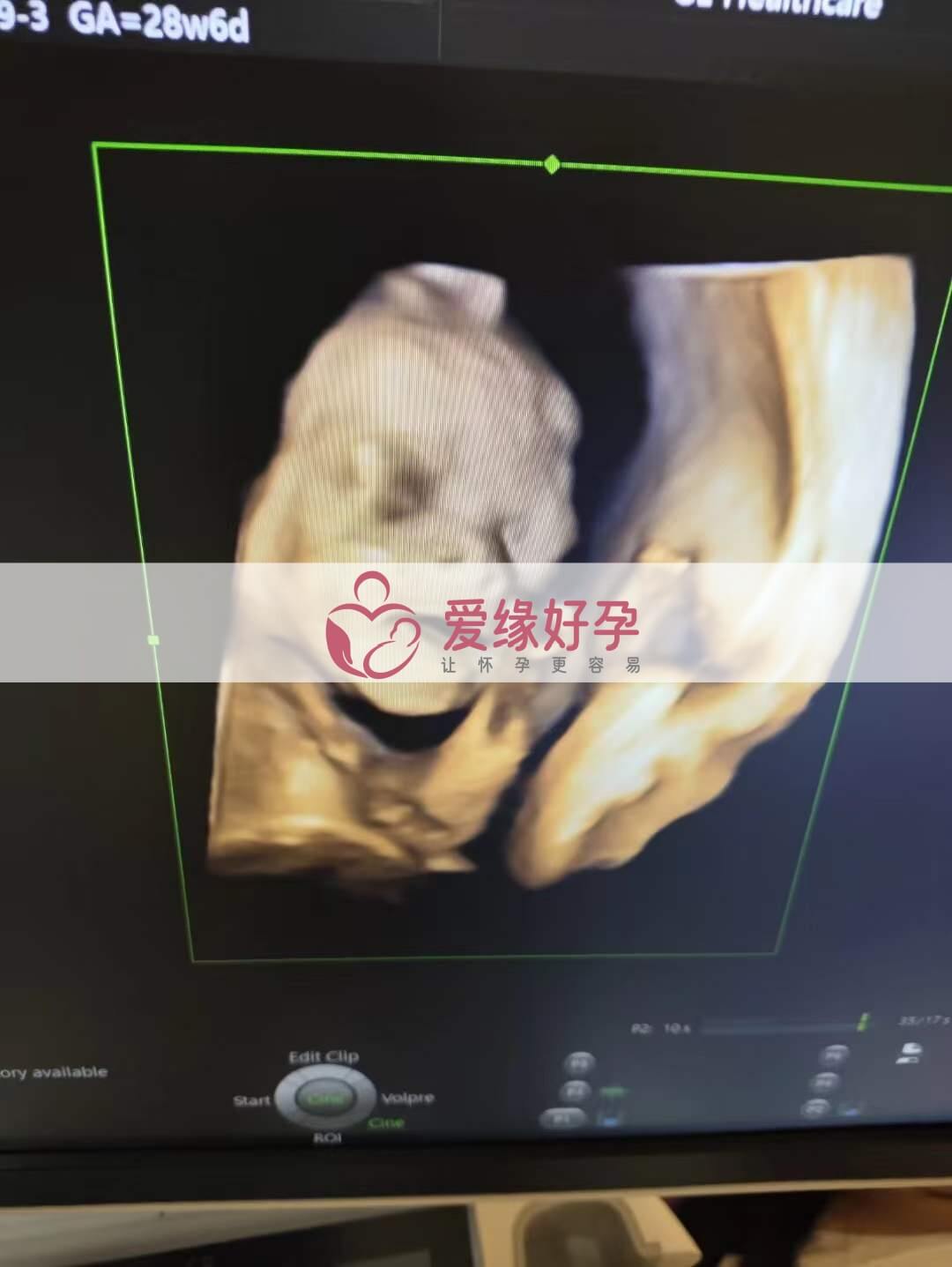 爱缘好孕乌克兰代孕代母孕28周产检顺利通过