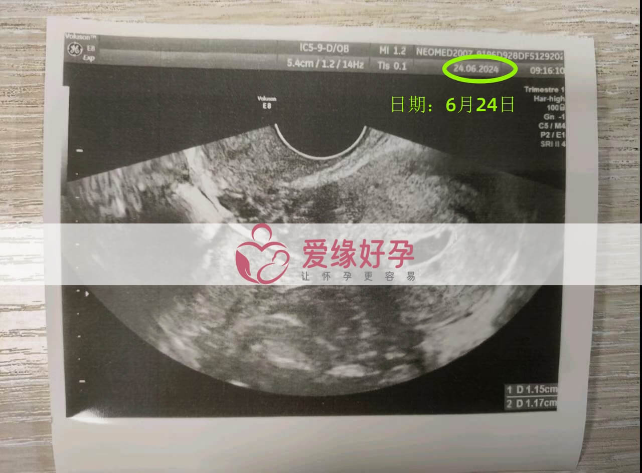 爱缘好孕乌克兰代孕代母第一次孕检顺利通过