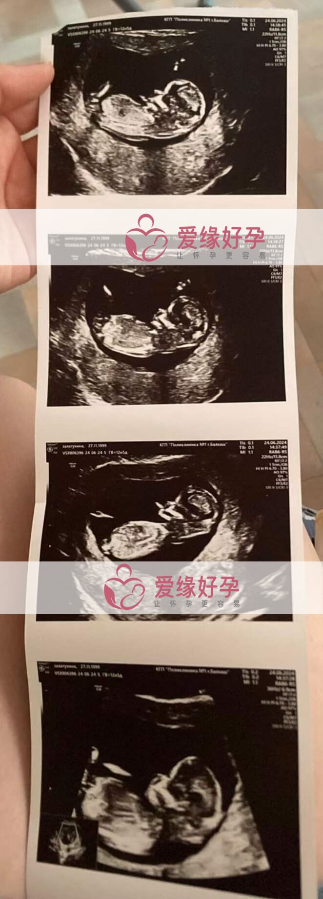 爱缘好孕哈萨克斯坦代孕代母12周产检顺利通过
