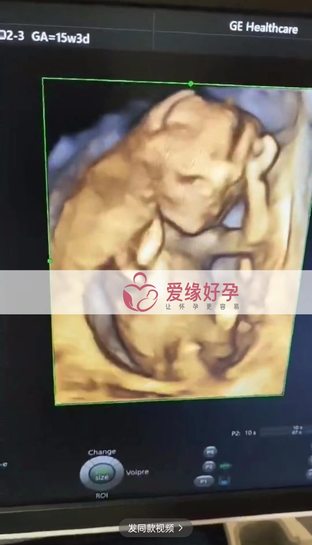 爱缘好孕乌克兰代孕代母孕15周产检顺利通过