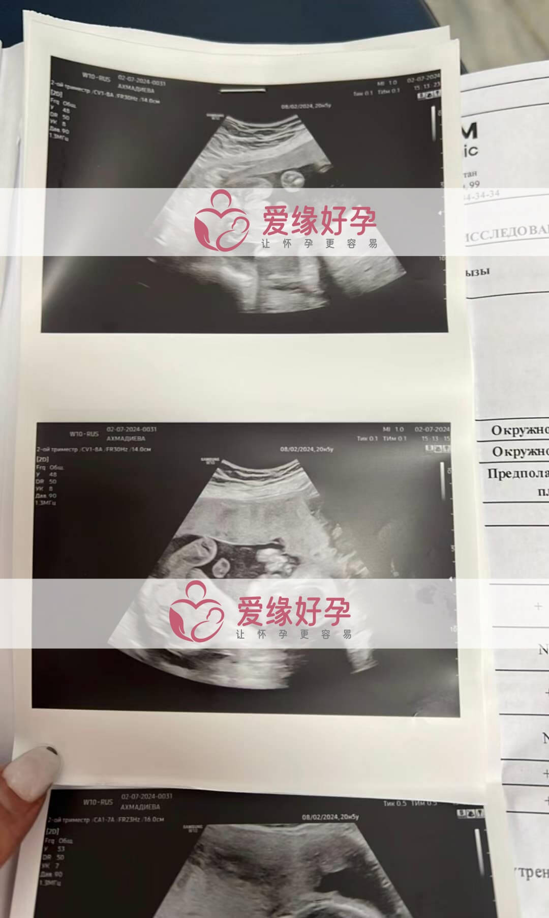 爱缘好孕哈萨克斯坦代孕代母孕20周产检顺利通过