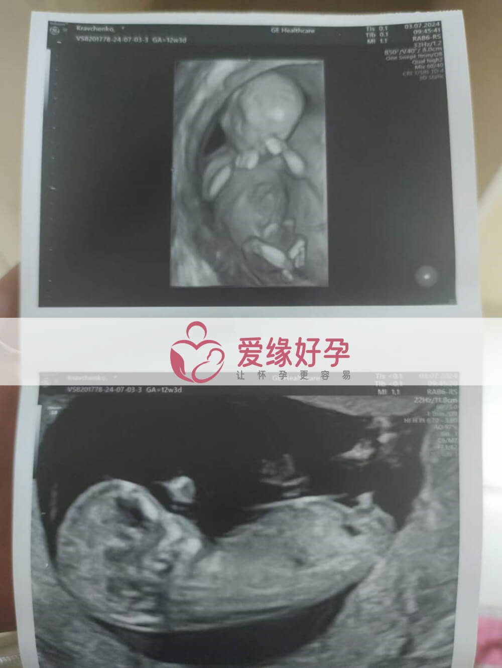 爱缘好孕格鲁吉亚代孕代母孕12周产检顺利通过