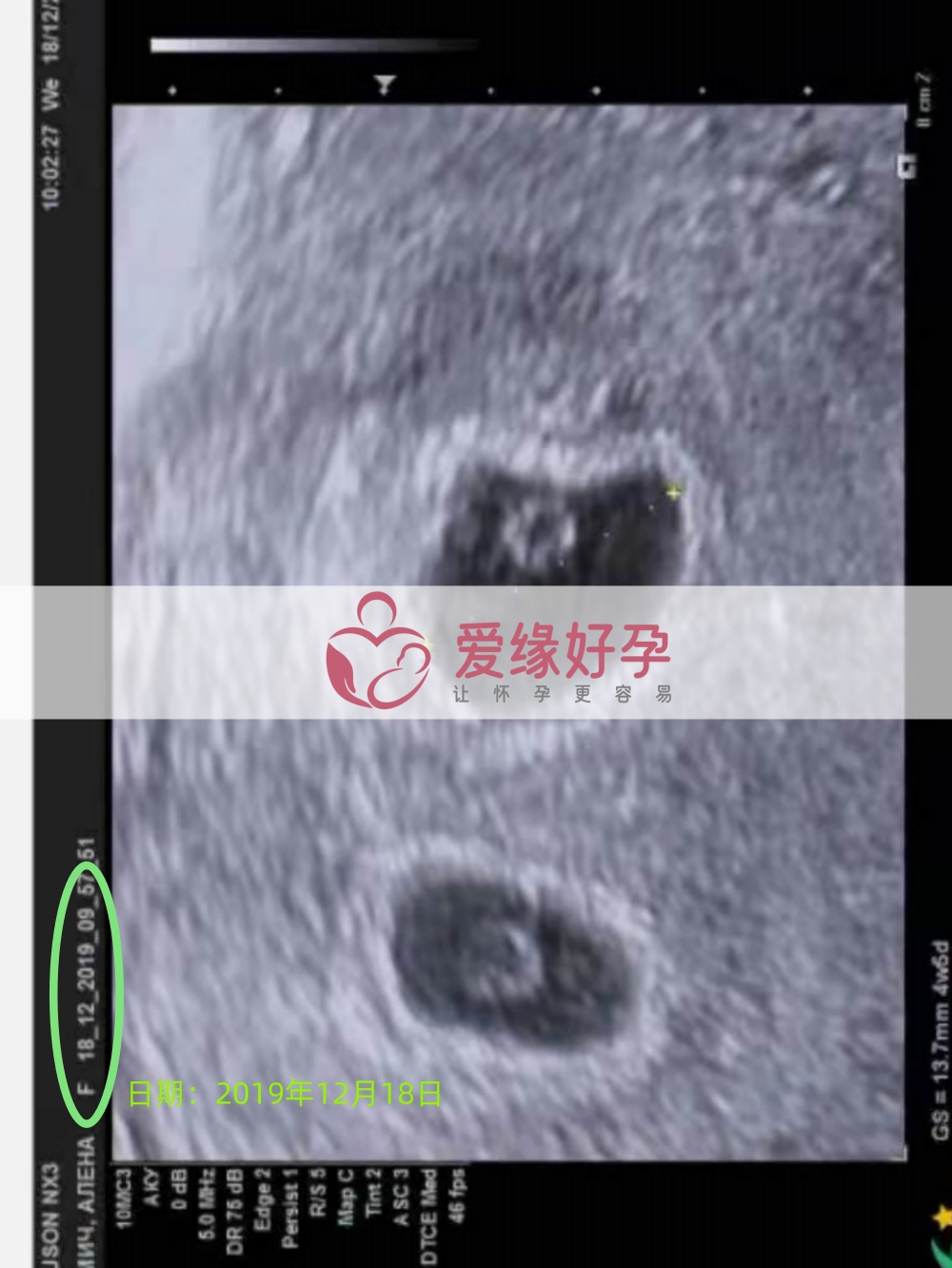 爱缘好孕乌克兰代孕代母第一次B超顺利通过