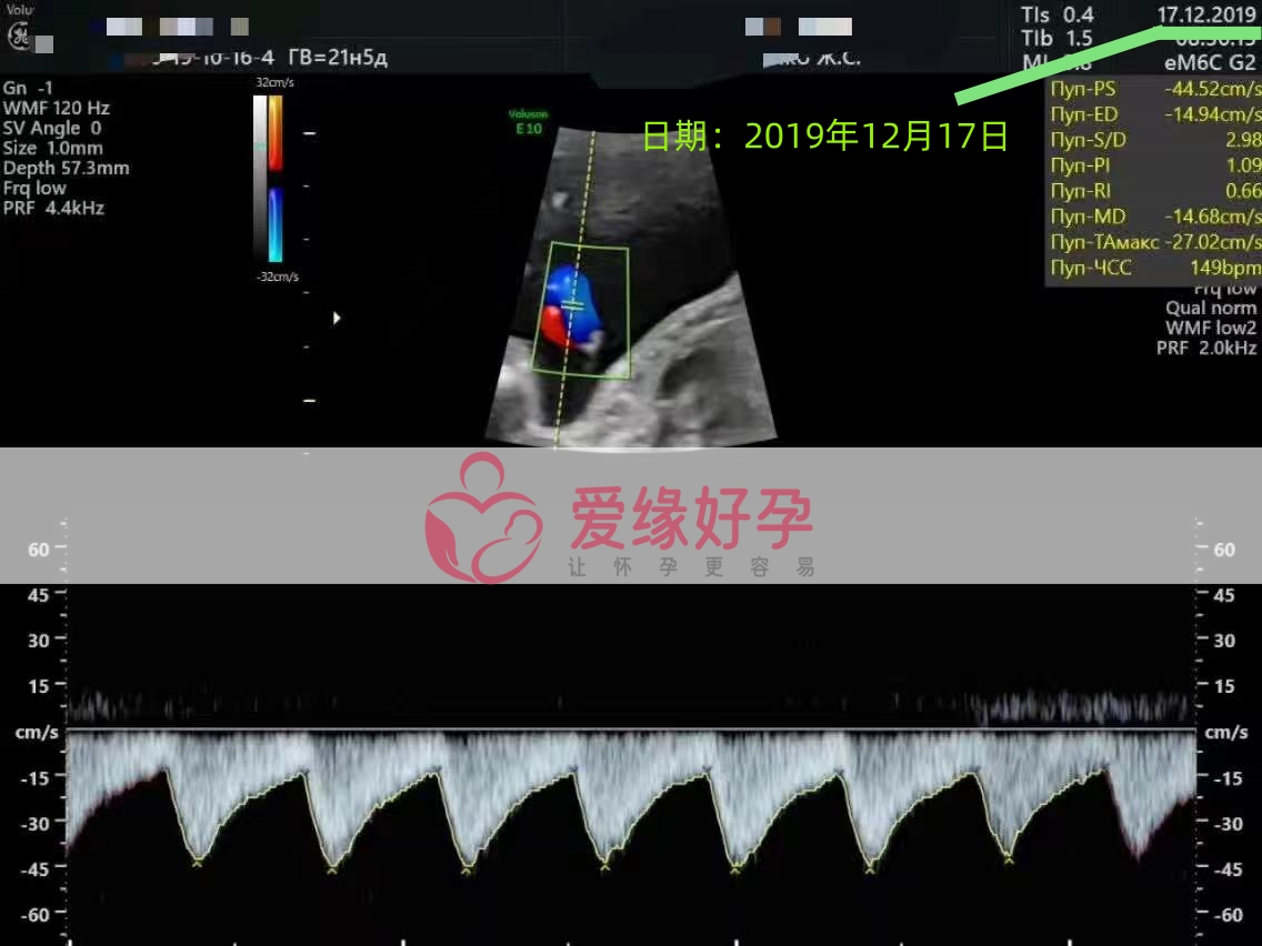 爱缘好孕乌克兰代孕代母21周产检顺利通过