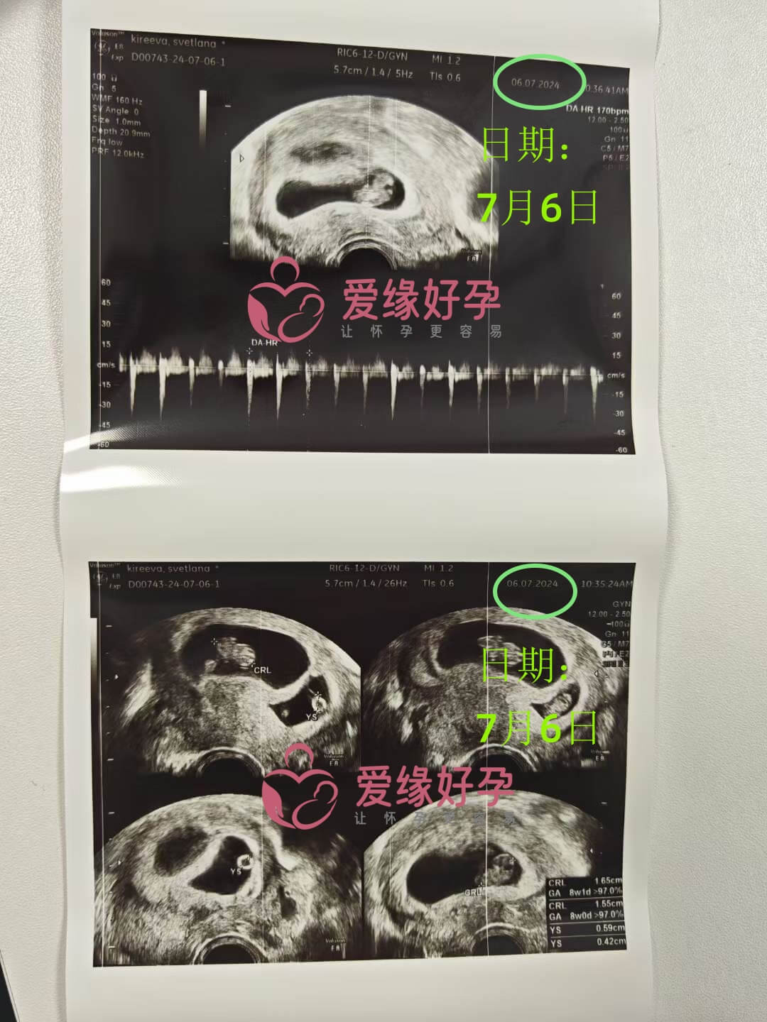 爱缘好孕格鲁吉亚代孕代母孕8周产检顺利通过