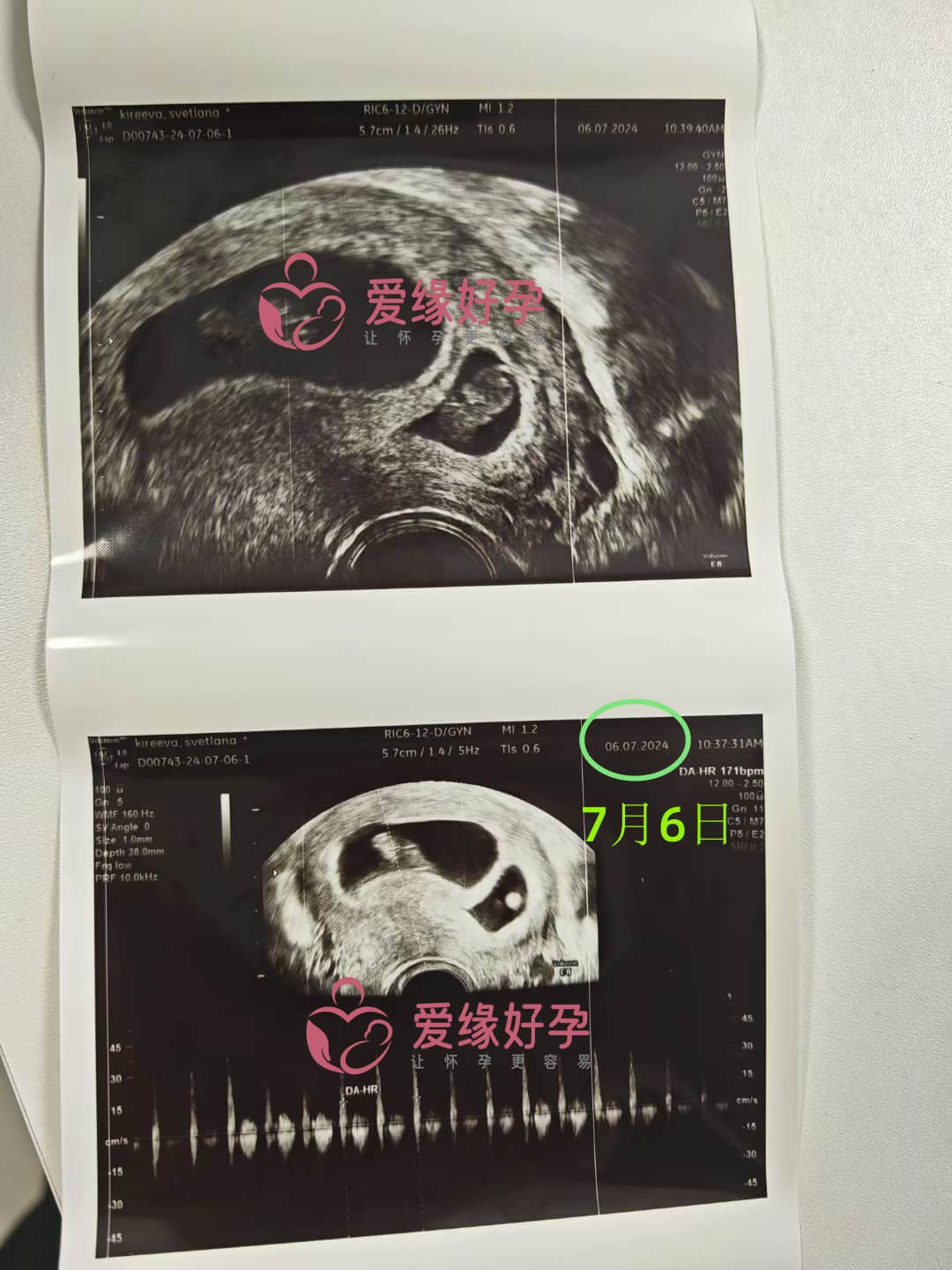 爱缘好孕格鲁吉亚代孕代母孕8周产检顺利通过