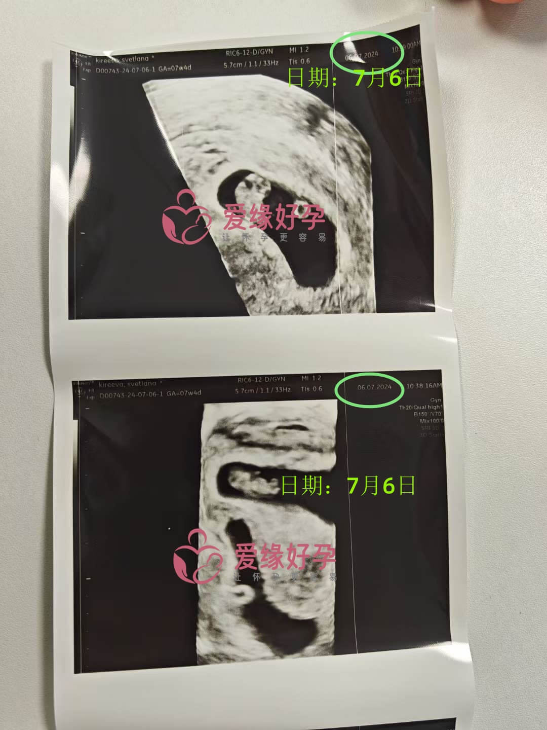 爱缘好孕格鲁吉亚代孕代母孕8周产检顺利通过
