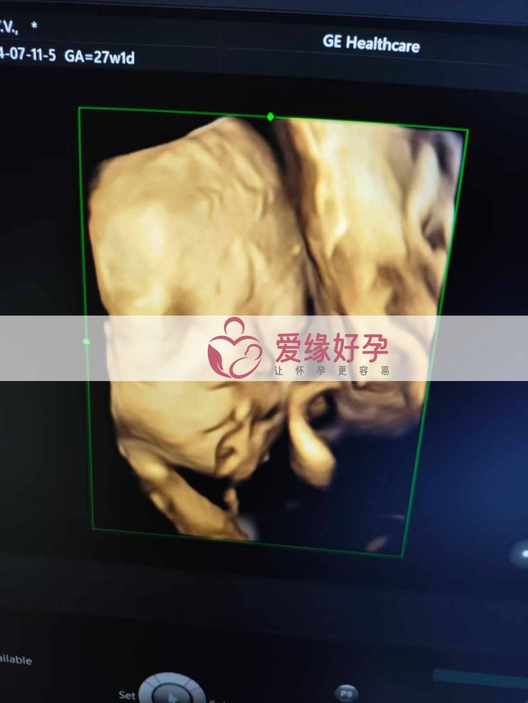 爱缘好孕乌克兰代孕代母26周产检顺利通过