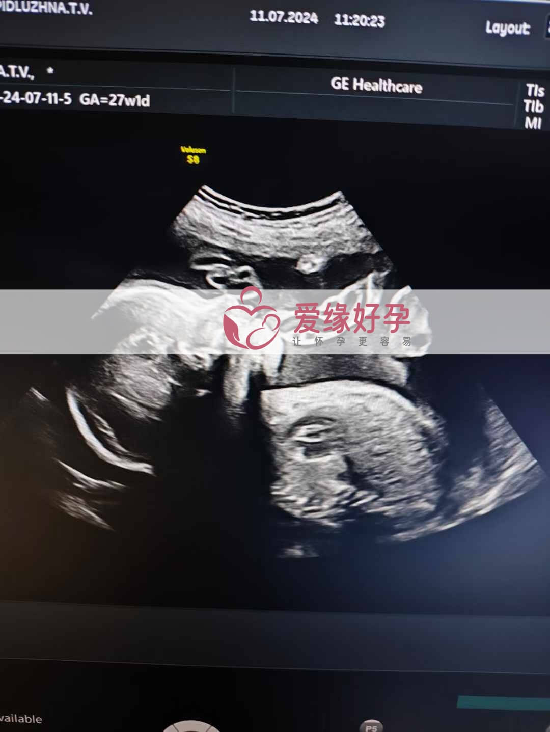 爱缘好孕乌克兰代孕代母26周产检顺利通过