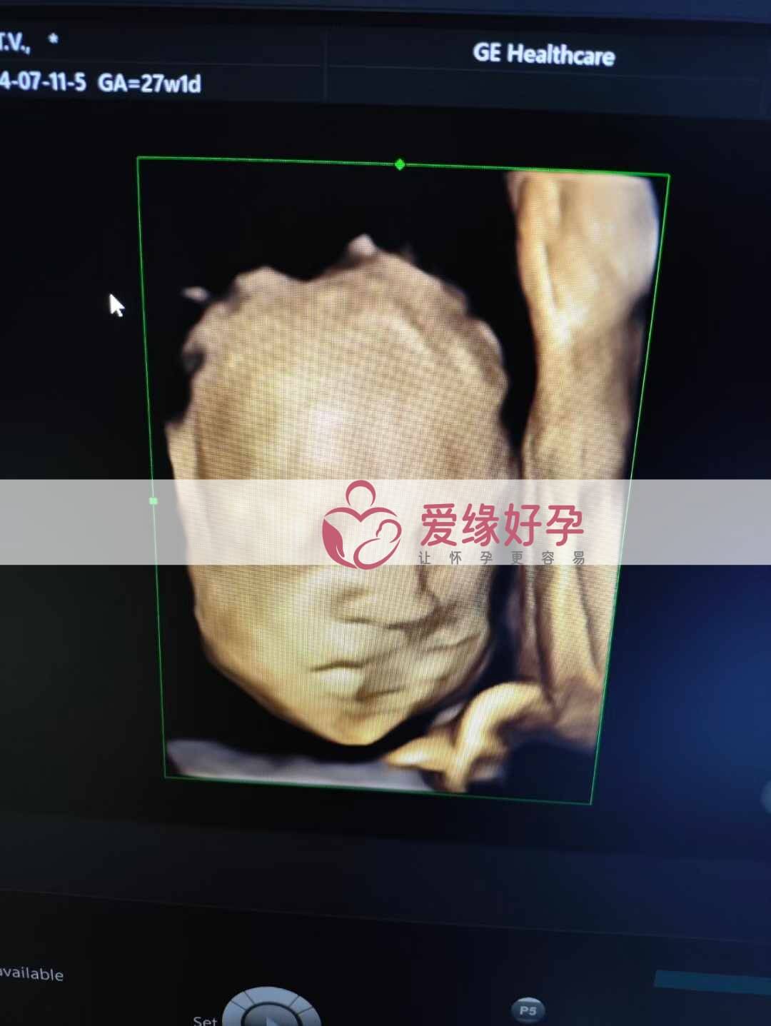 爱缘好孕乌克兰代孕代母26周产检顺利通过