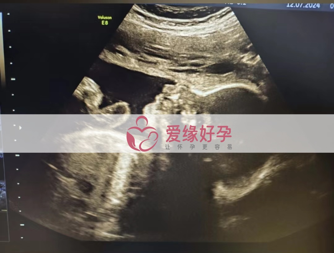爱缘好孕乌克兰代孕代母孕27周产检顺利通过