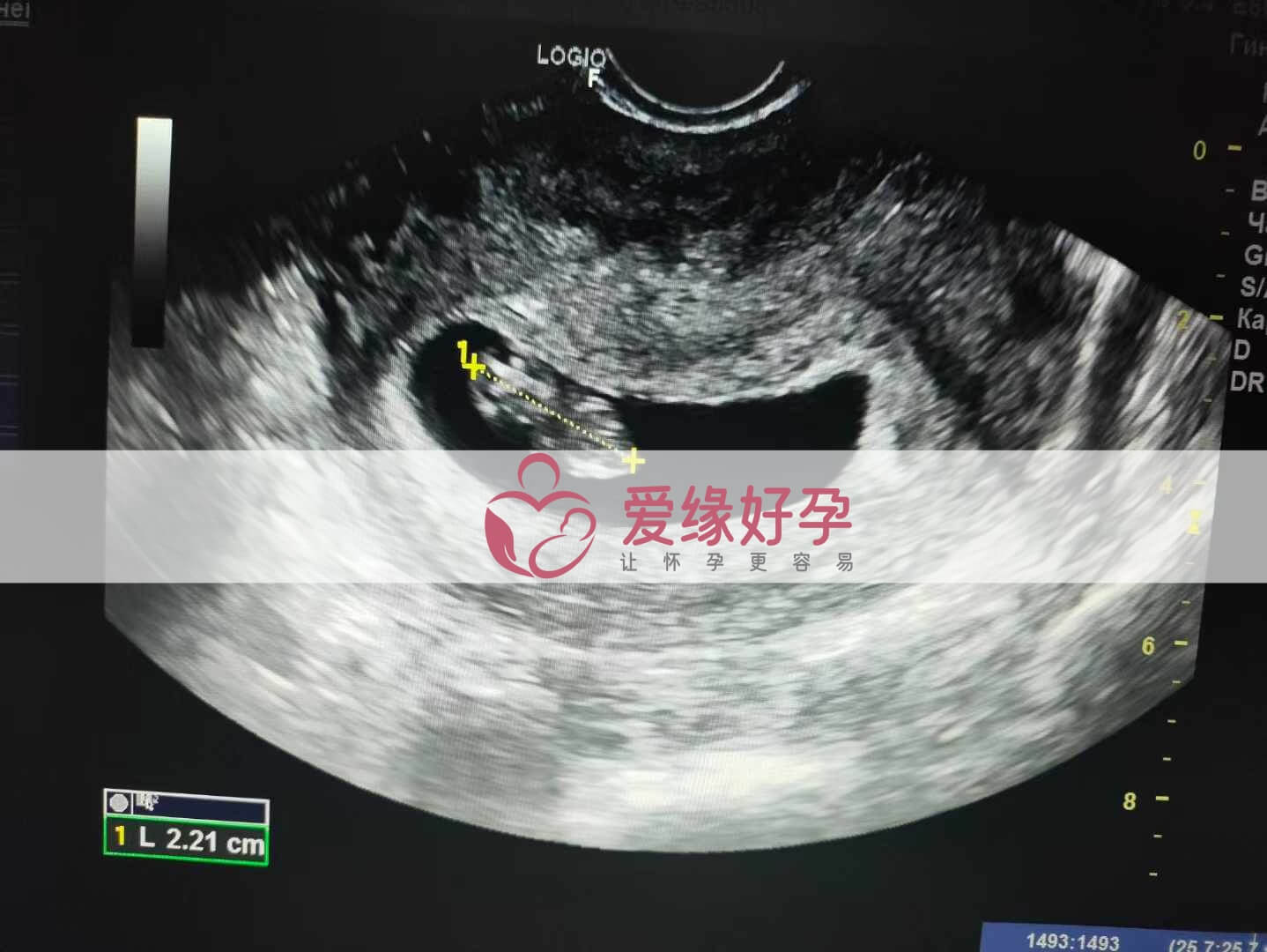 爱缘好孕乌克兰代孕代母孕8周产检顺利通过