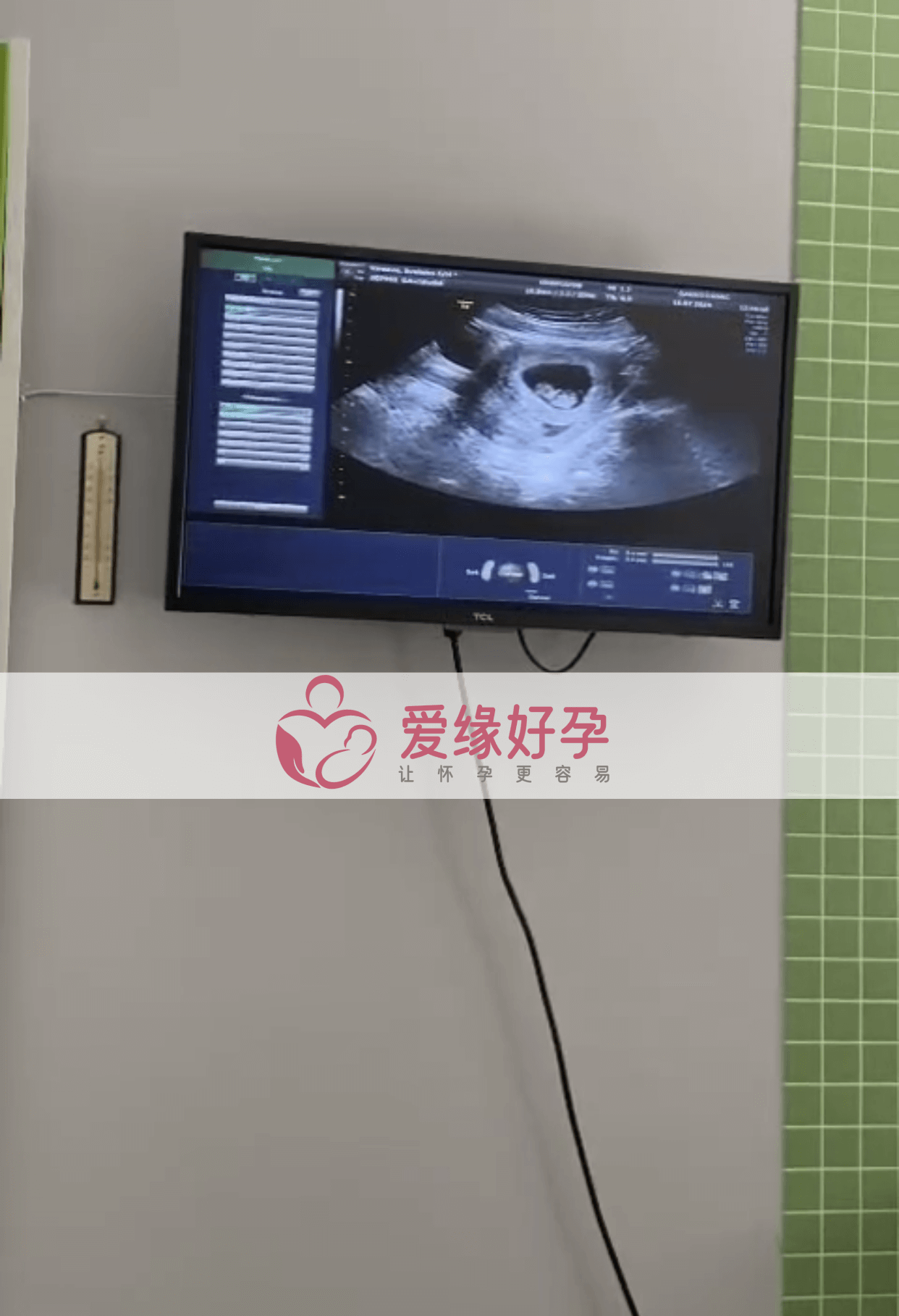 爱缘好孕格鲁吉亚代孕代母孕10周产检顺利通过