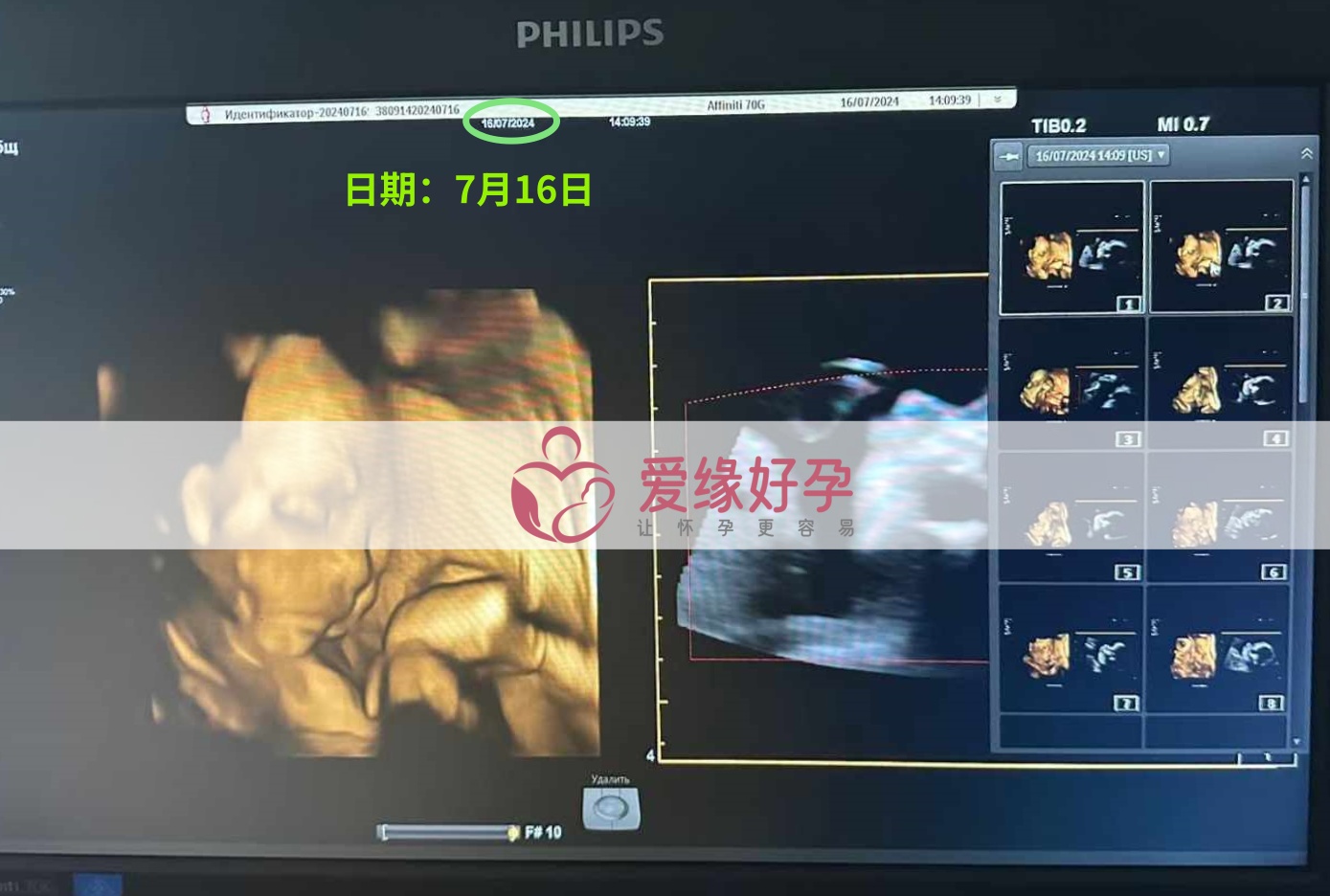爱缘好孕哈萨克斯坦代孕代母孕25周产检顺利通过
